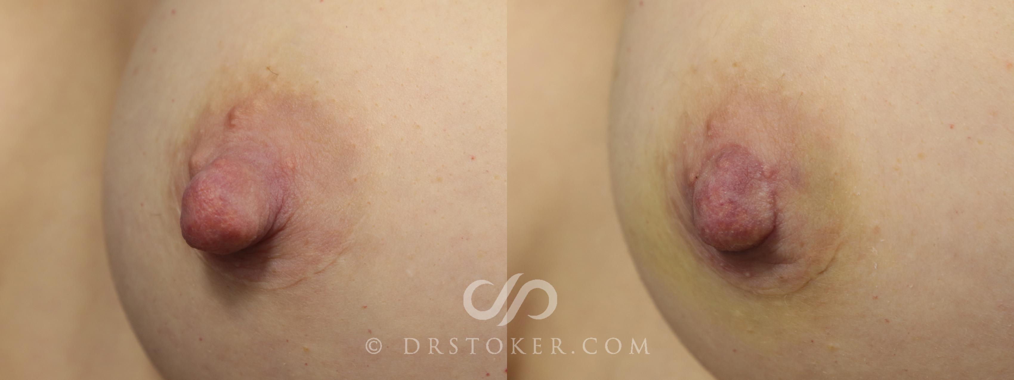 Before & After Nipple Reduction Case 1207 View #1 View in Marina del Rey, CA