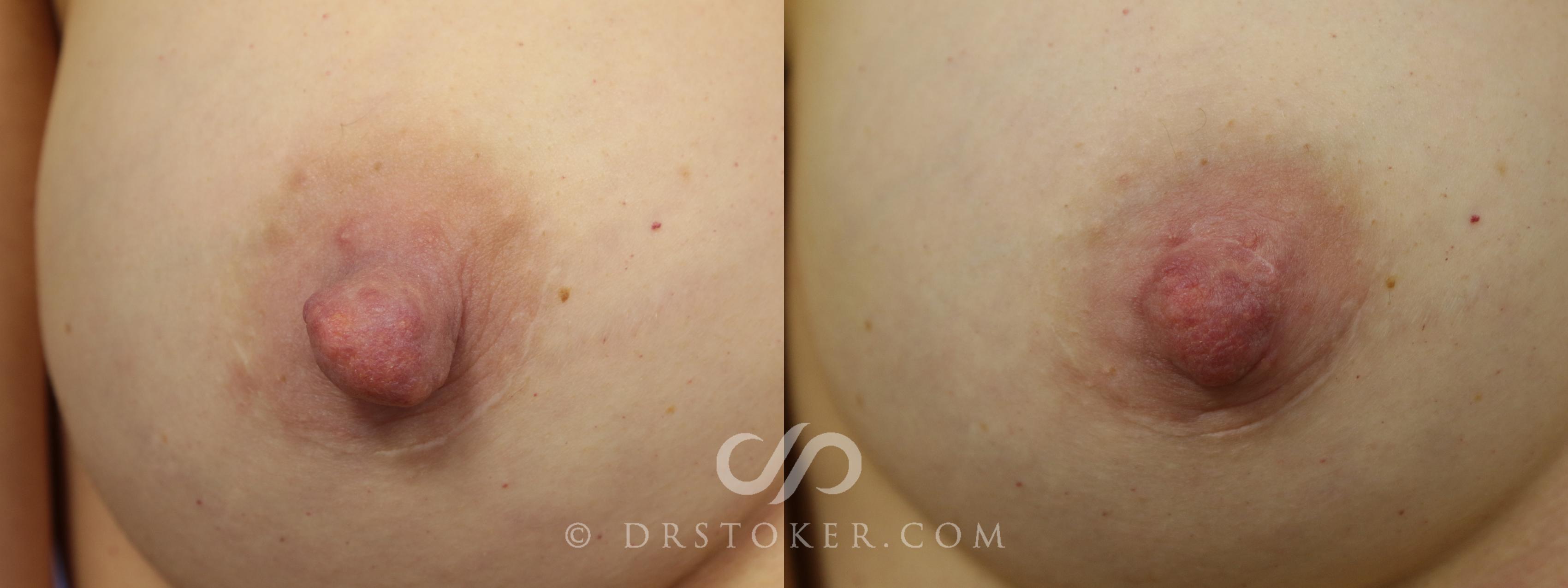 Before & After Nipple - Reduction Case 1208 View #1 View in Los Angeles, CA
