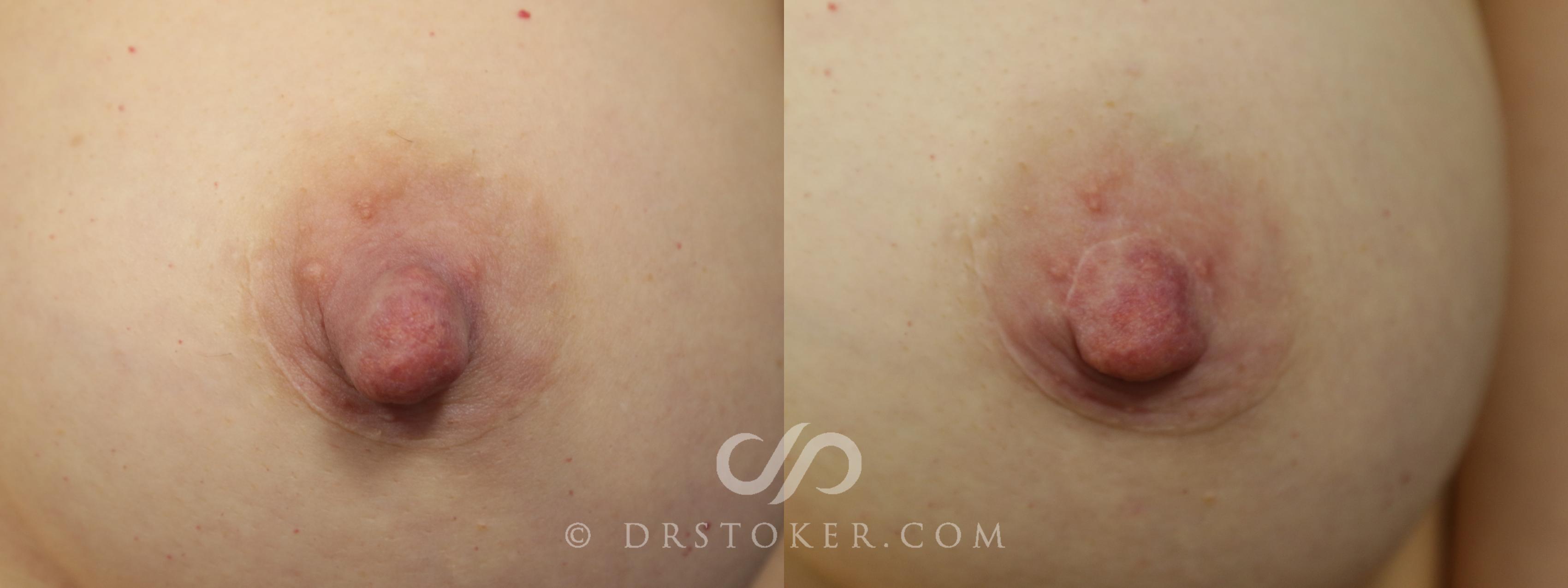 Before & After Nipple - Reduction Case 1209 View #1 View in Los Angeles, CA