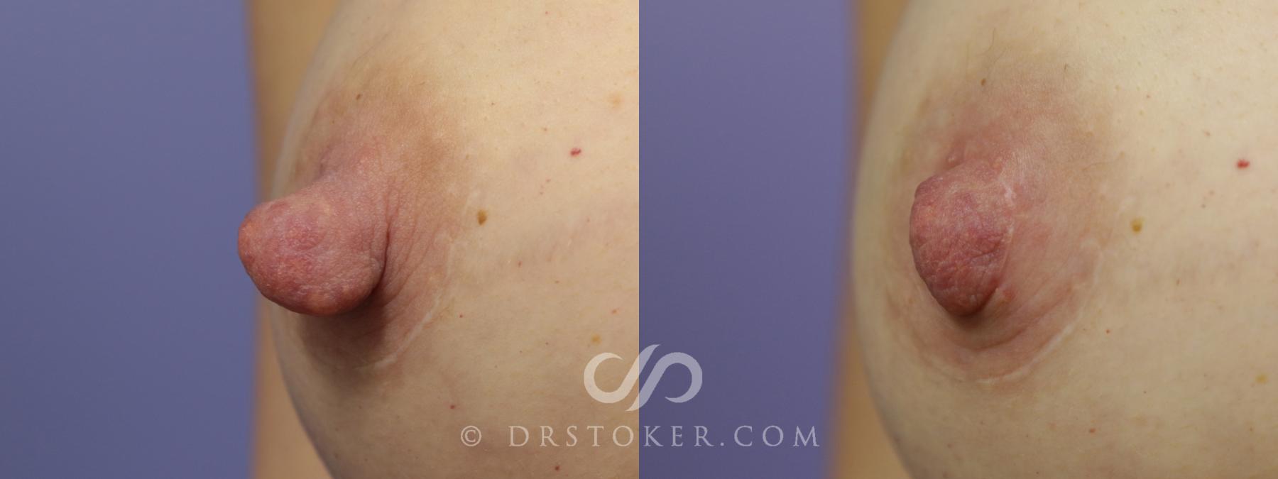 Before & After Nipple - Reduction Case 1210 View #1 View in Los Angeles, CA