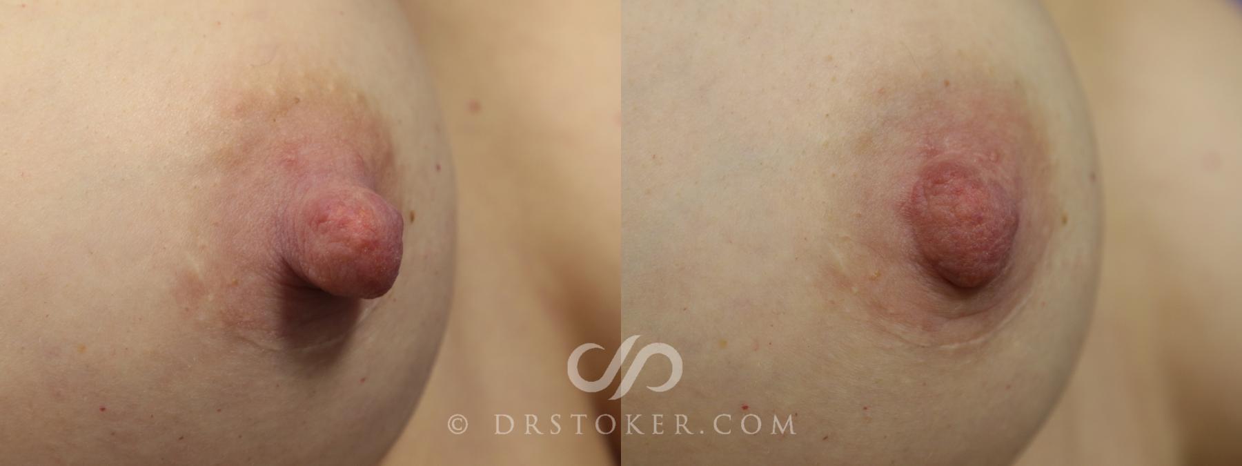 Before & After Nipple - Reduction Case 1211 View #1 View in Los Angeles, CA