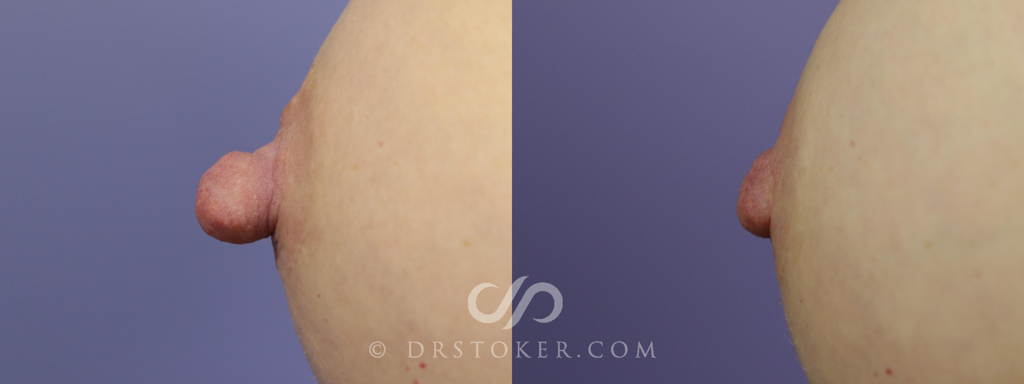 Before & After Nipple - Reduction Case 1212 View #1 View in Los Angeles, CA