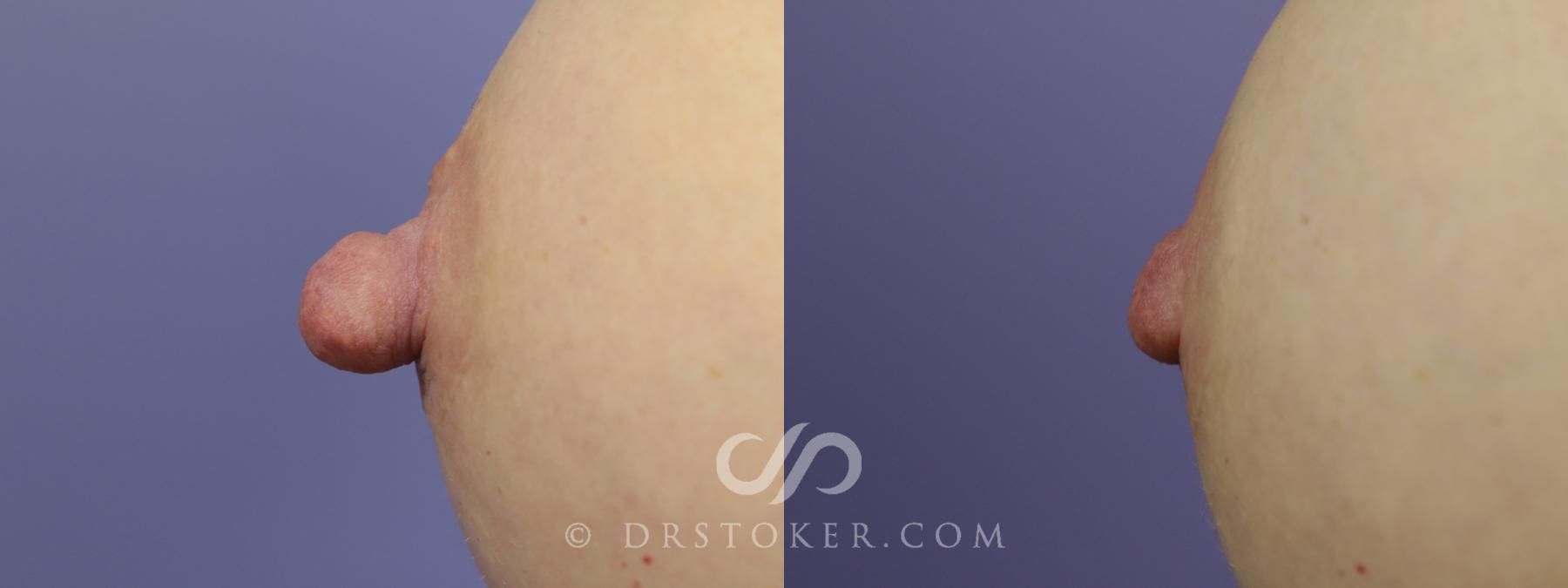 Before & After Nipple - Reduction Case 1212 View #1 View in Los Angeles, CA