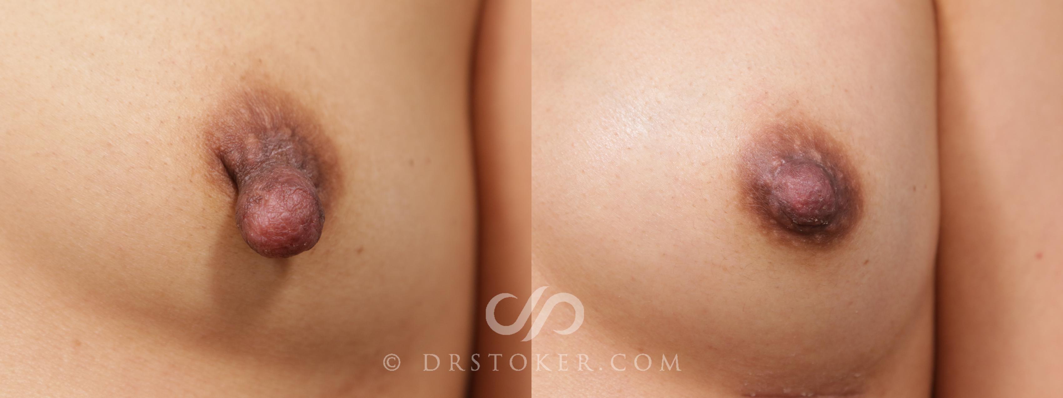 Before & After Nipple - Reduction Case 2107 Front View in Los Angeles, CA