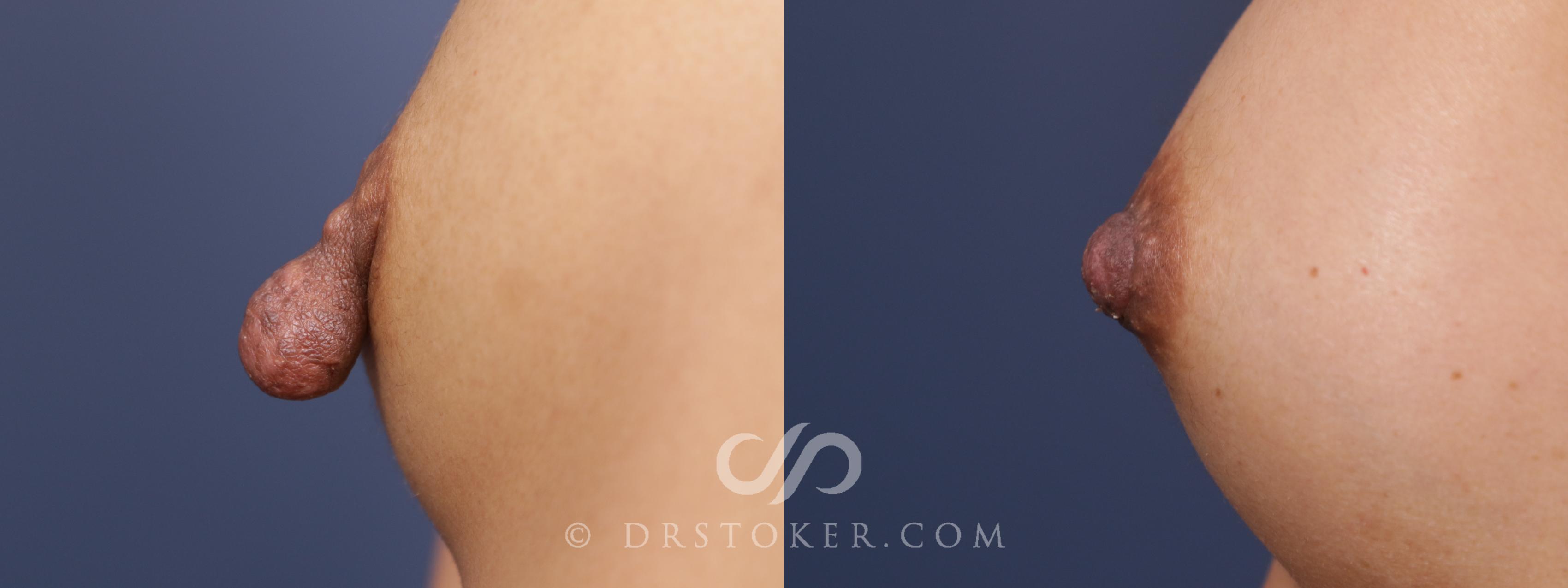 Before & After Nipple Reduction Case 2107 Left Side View in Marina del Rey, CA