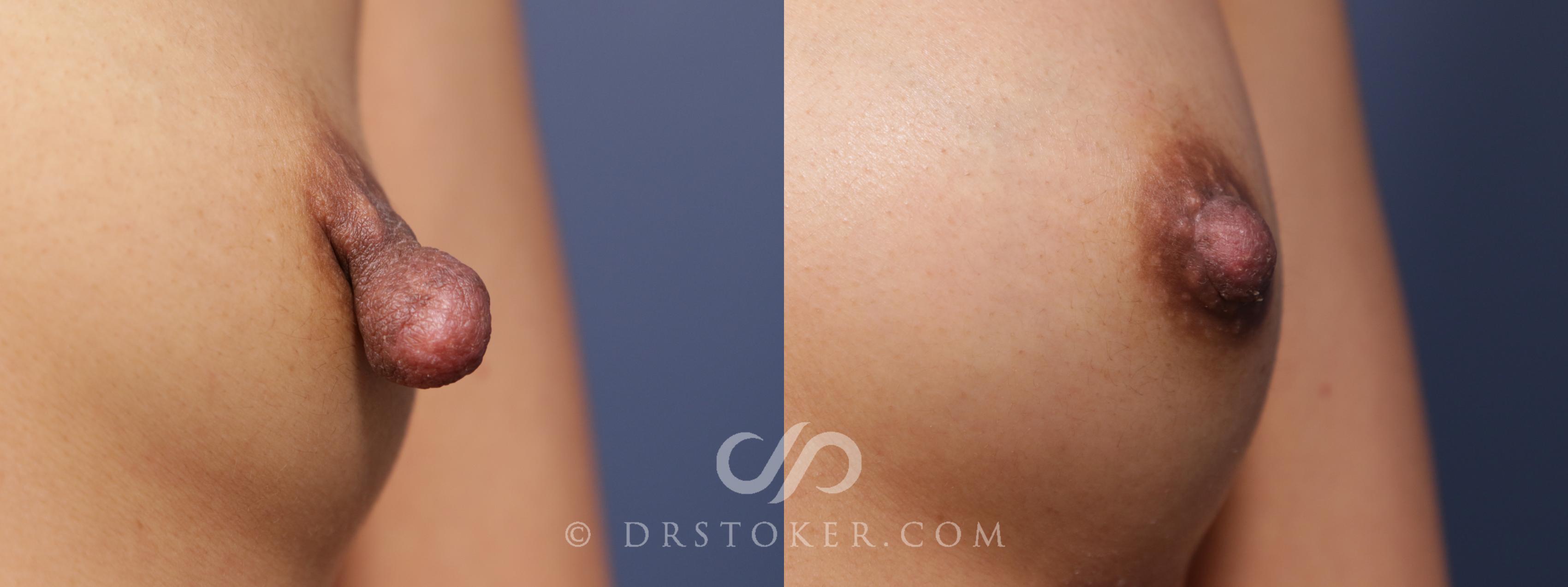 Before & After Nipple - Reduction Case 2107 Right Oblique View in Los Angeles, CA