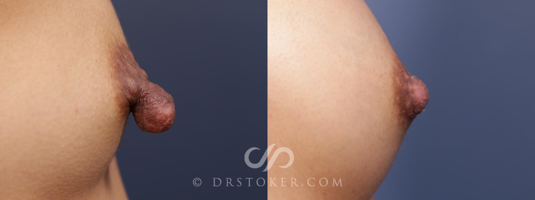 Before & After Nipple - Reduction Case 2107 Right Side View in Los Angeles, CA