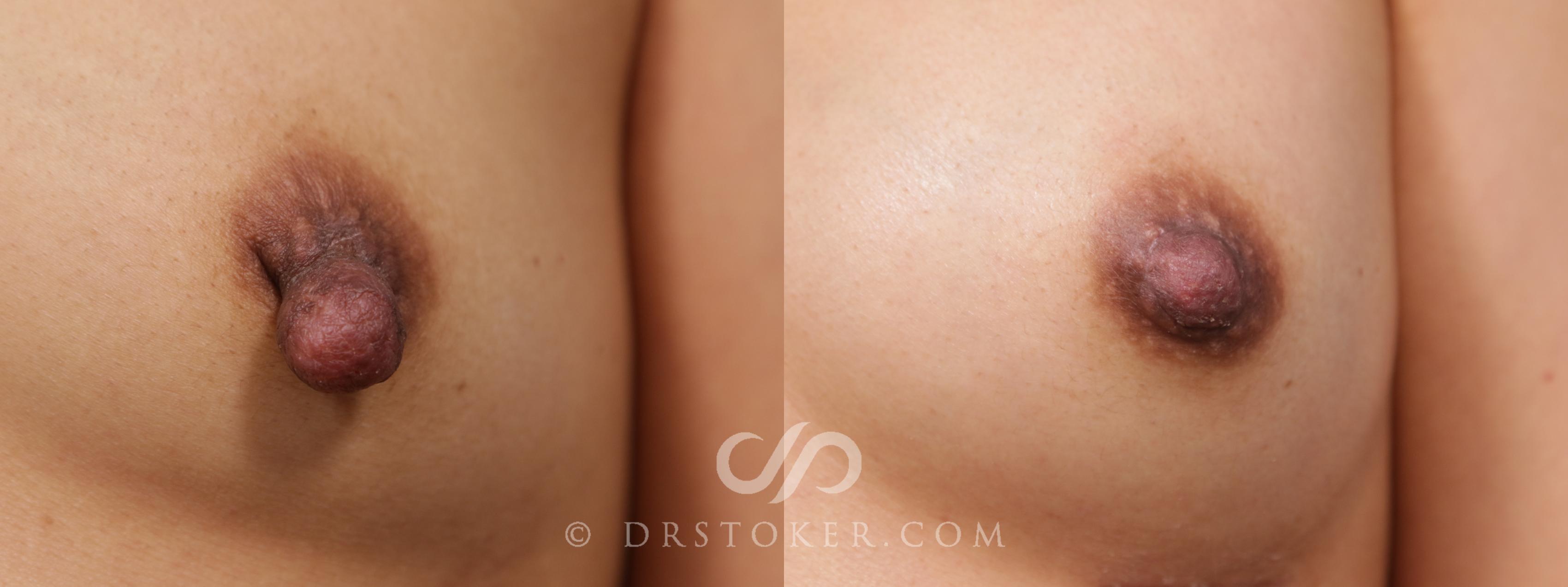 Before & After Nipple - Reduction Case 2109 Front View in Los Angeles, CA