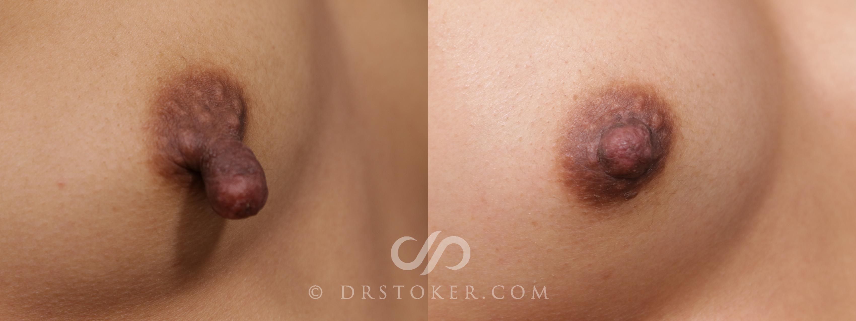 Before & After Nipple - Reduction Case 2110 Right Oblique View in Los Angeles, CA