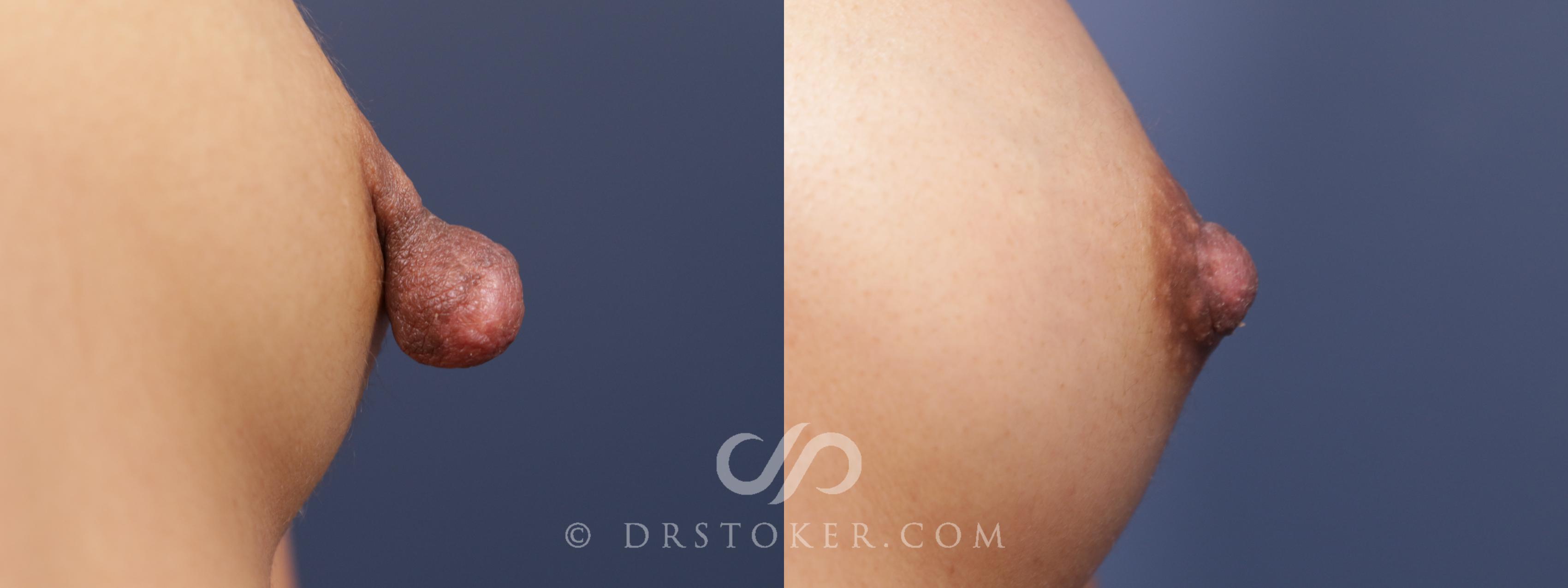 Before & After Nipple - Reduction Case 2111 Right Side View in Los Angeles, CA