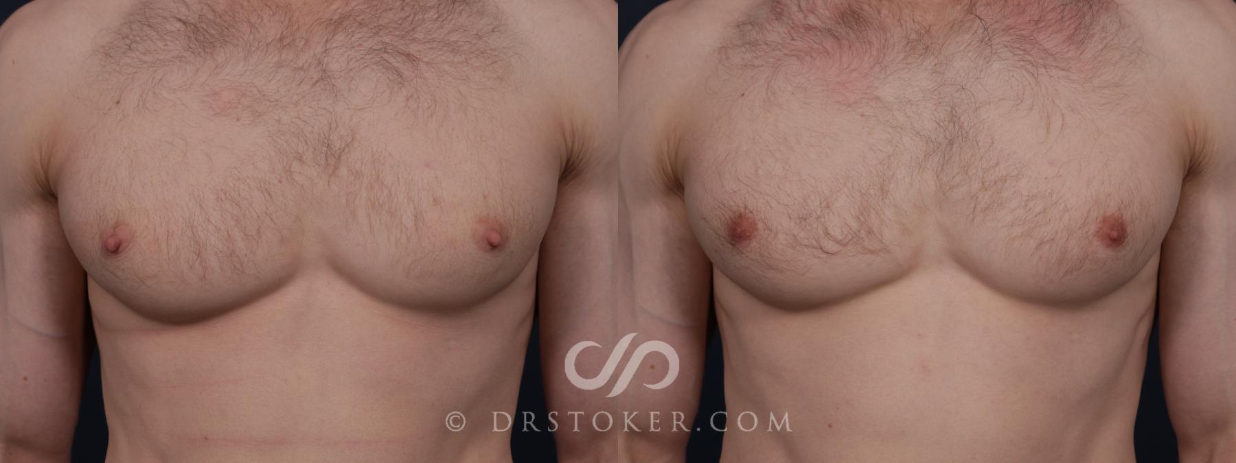 Before & After Nipple - Reduction Case 2169 Front View in Los Angeles, CA