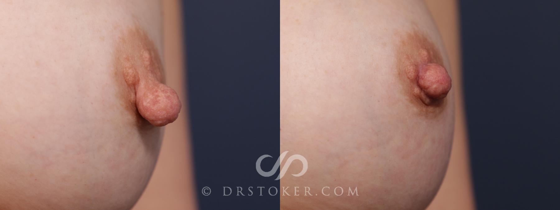 Before & After Nipple - Reduction Case 2175 Left Oblique View in Los Angeles, CA