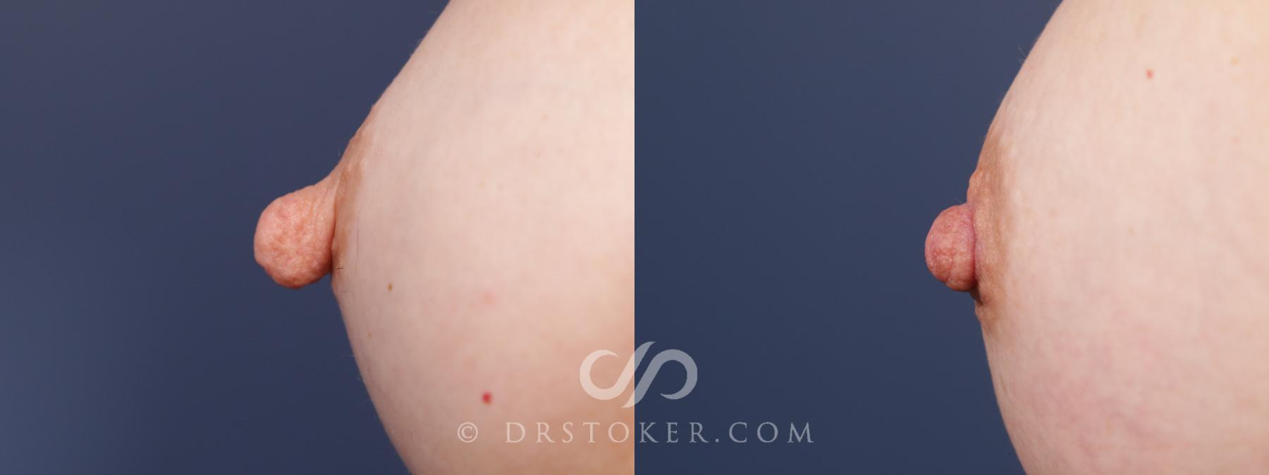 Before & After Nipple - Reduction Case 2175 Left Side View in Los Angeles, CA