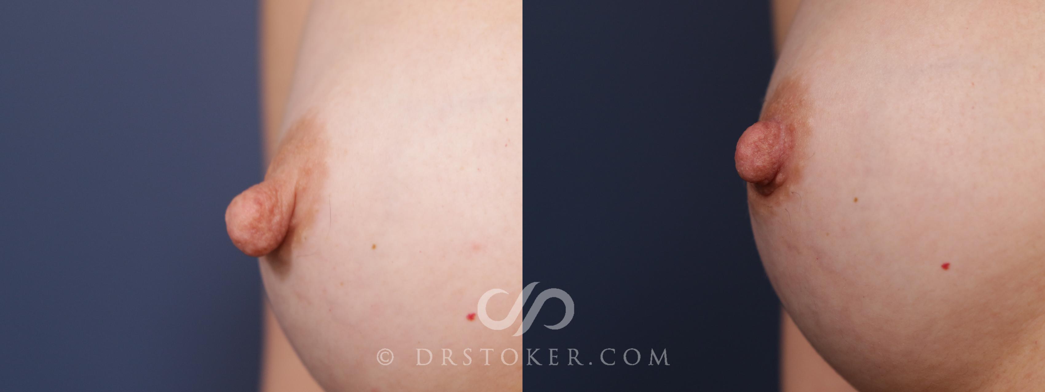 Before & After Nipple - Reduction Case 2175 Right Oblique View in Los Angeles, CA