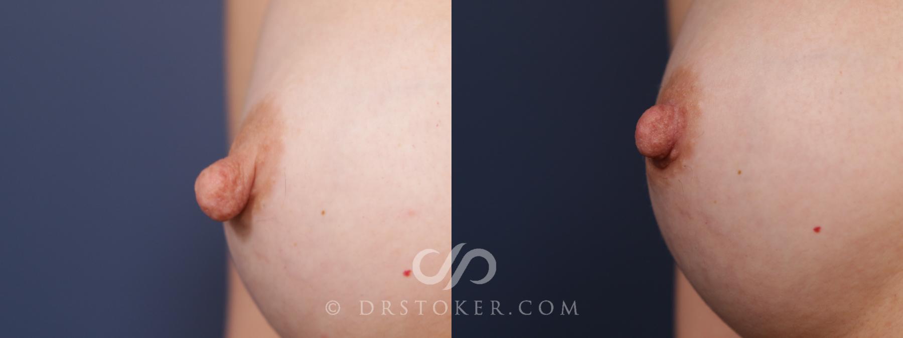 Before & After Nipple - Reduction Case 2175 Right Oblique View in Los Angeles, CA
