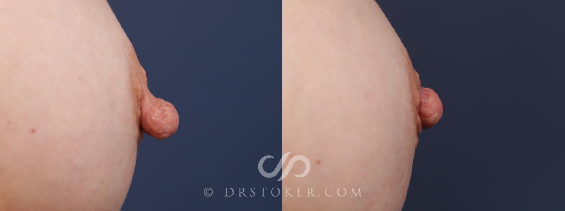 Before & After Nipple - Reduction Case 2175 Right Side View in Los Angeles, CA