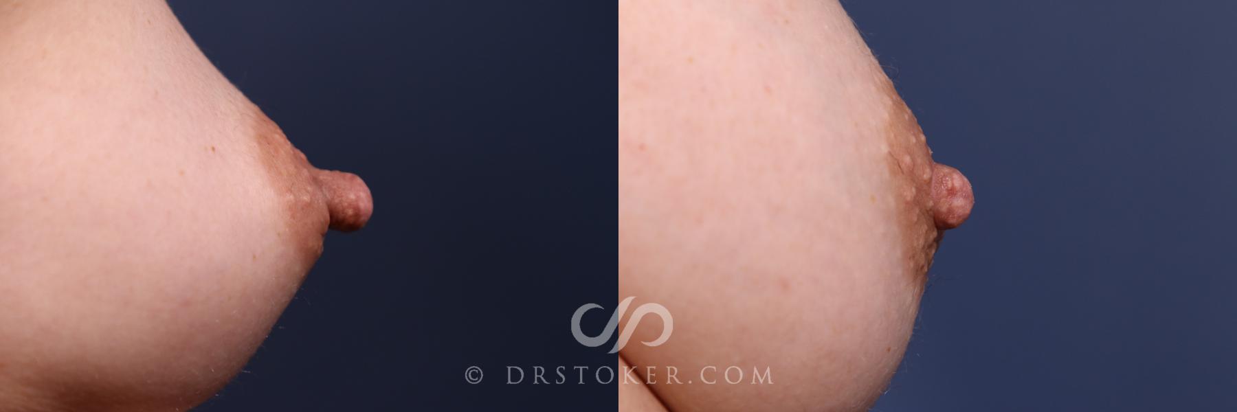 Before & After Nipple - Reduction Case 2564 Left Oblique View in Los Angeles, CA