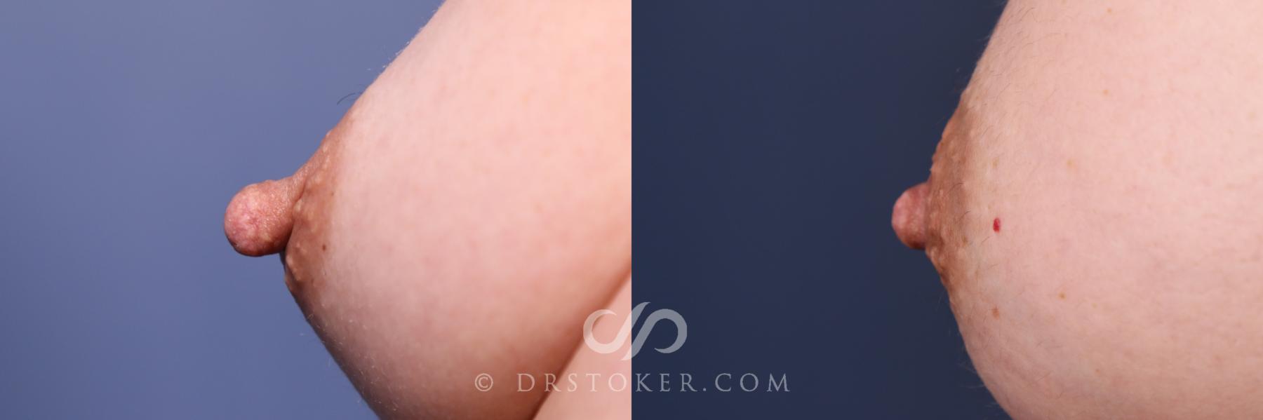 Before & After Nipple - Reduction Case 2564 Right Oblique View in Los Angeles, CA