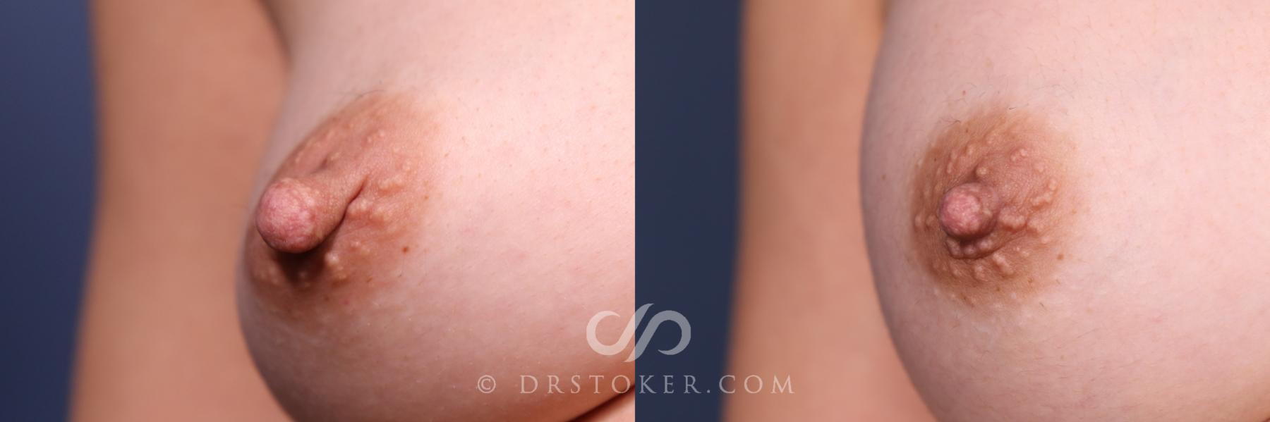 Before & After Nipple - Reduction Case 2564 Right Side View in Los Angeles, CA