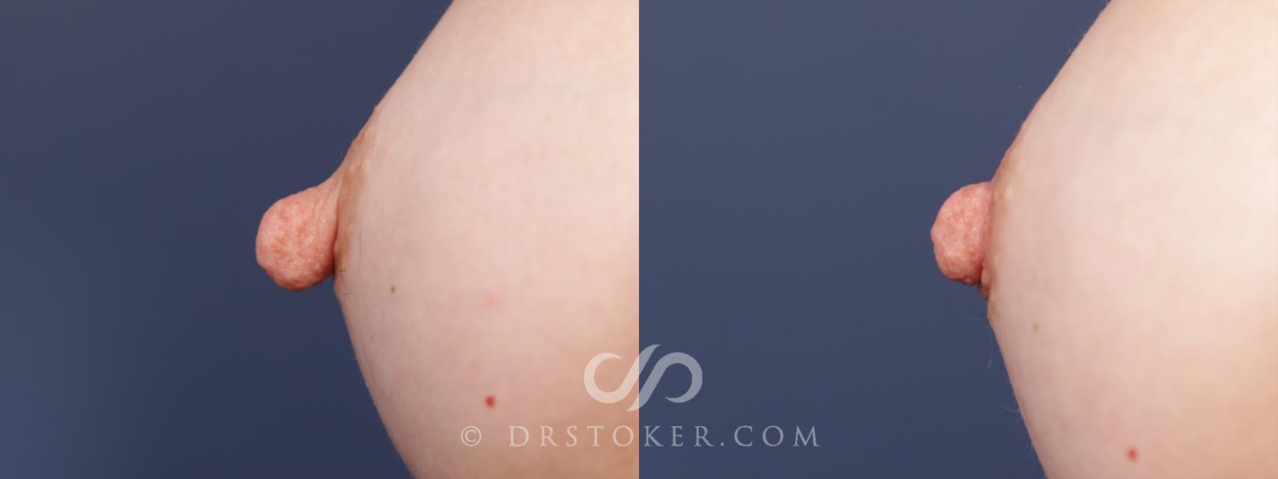 Before & After Nipple - Reduction Case 2582 Left Side View in Los Angeles, CA