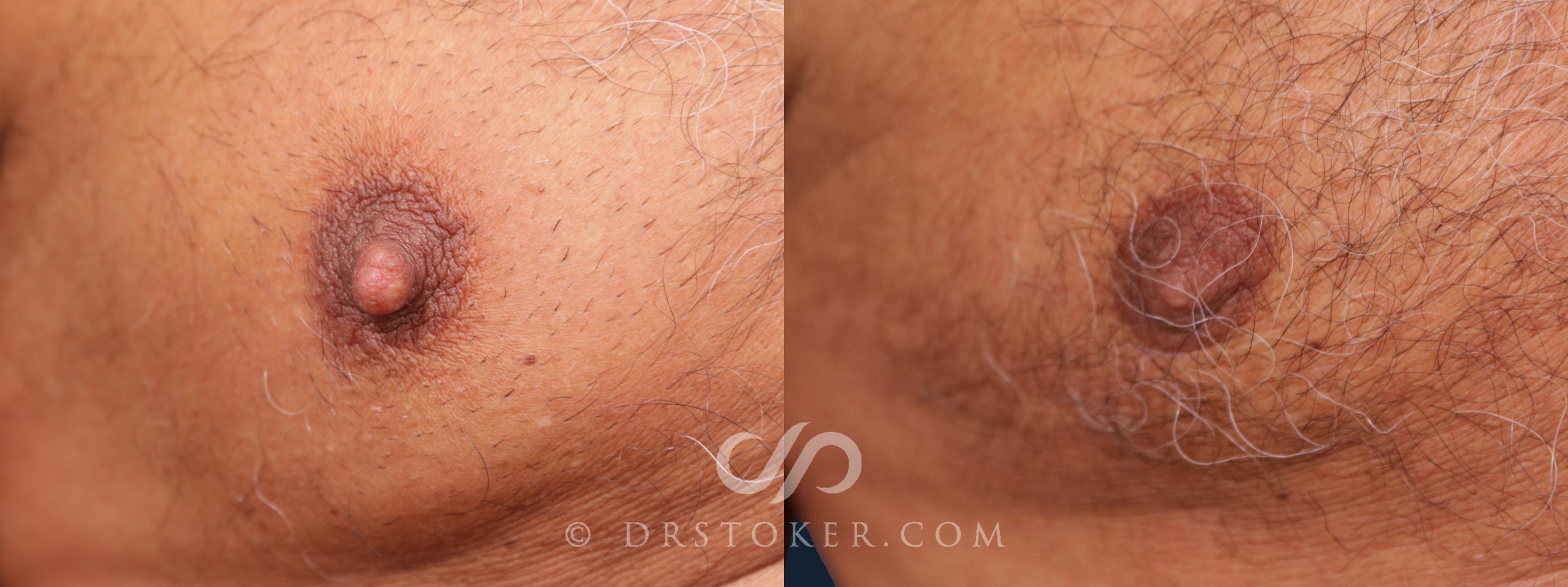 Before & After Breast Reduction for Men (Gynecomastia) Case 2024 Front View in Marina del Rey, CA