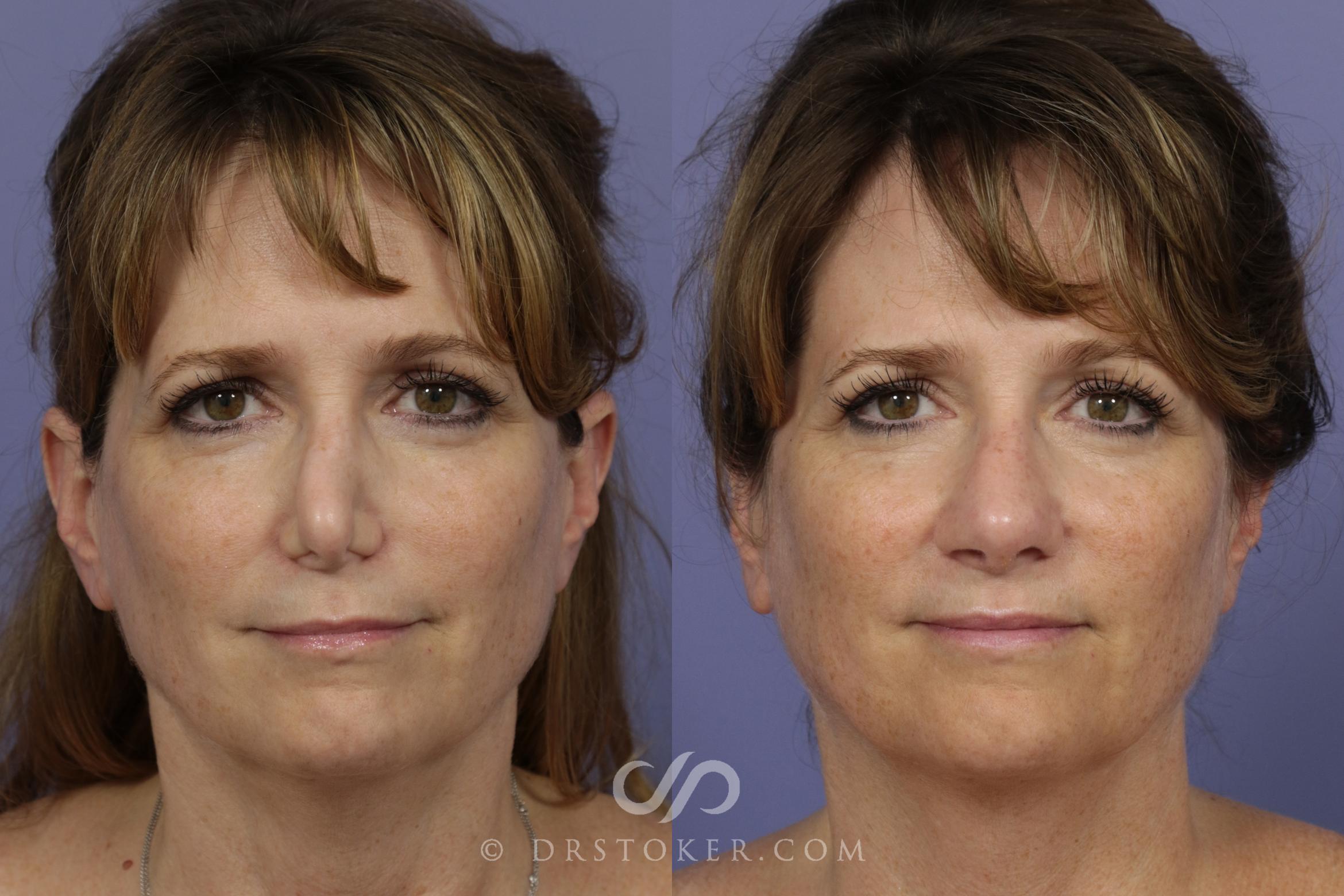 Before & After Rhinoplasty Case 1117 View #1 View in Los Angeles, CA