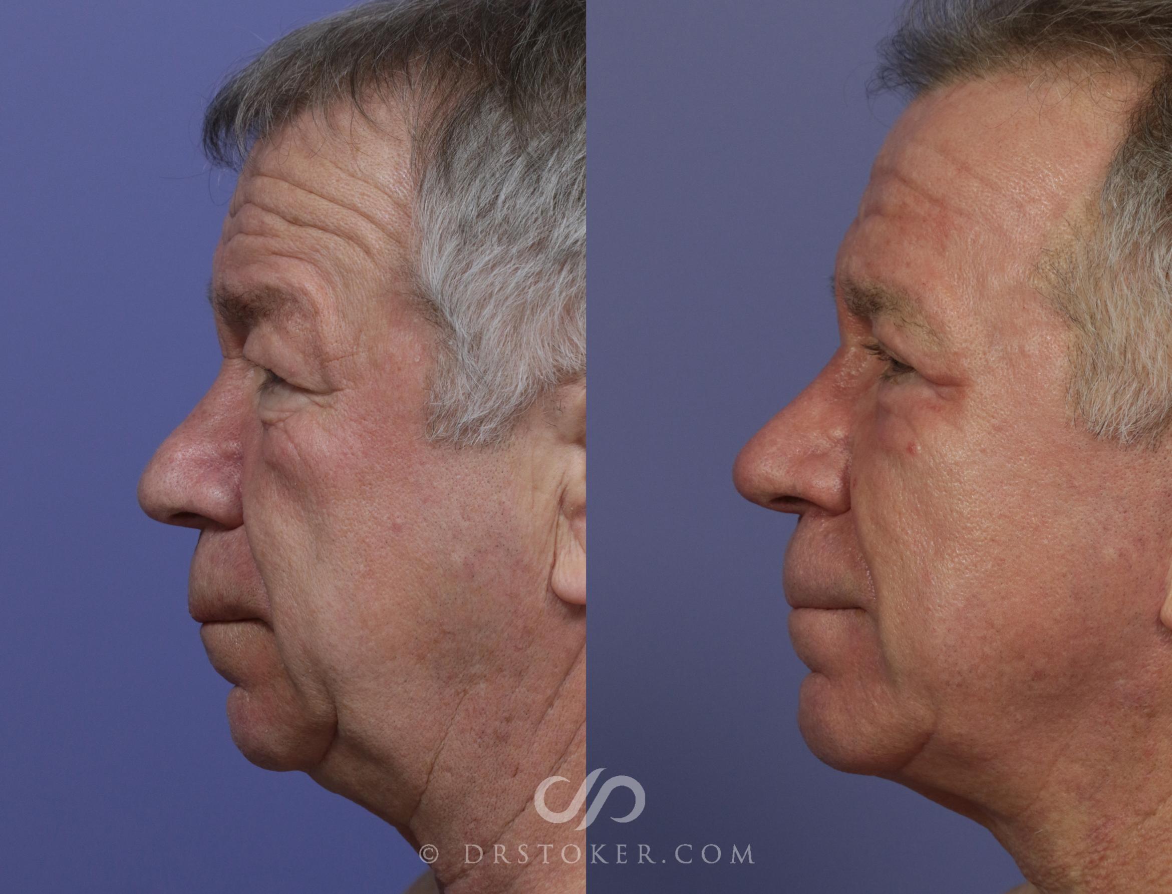 Before & After Rhinoplasty Case 1124 View #3 View in Los Angeles, CA
