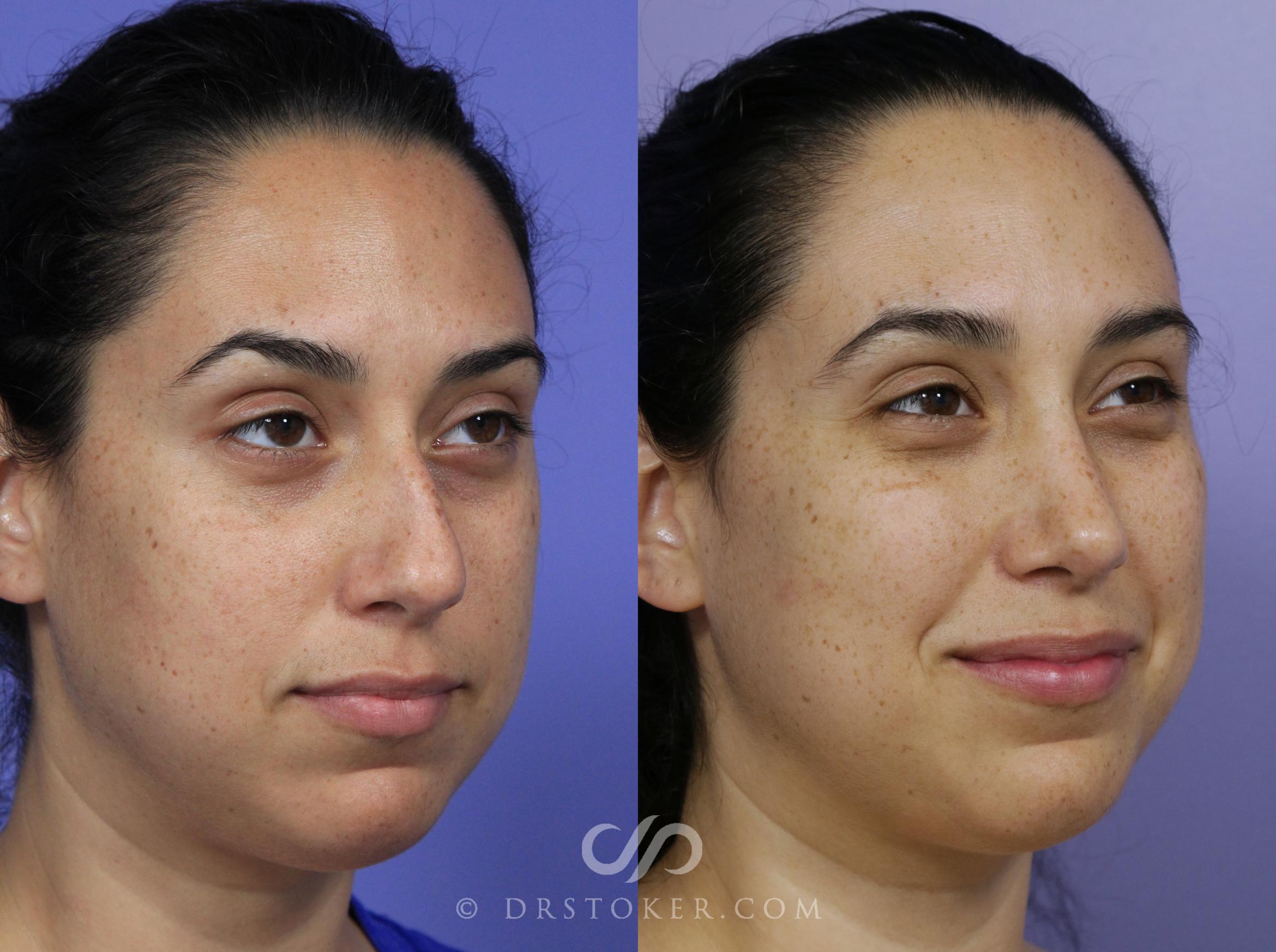 Before & After Rhinoplasty Case 1126 View #1 View in Los Angeles, CA