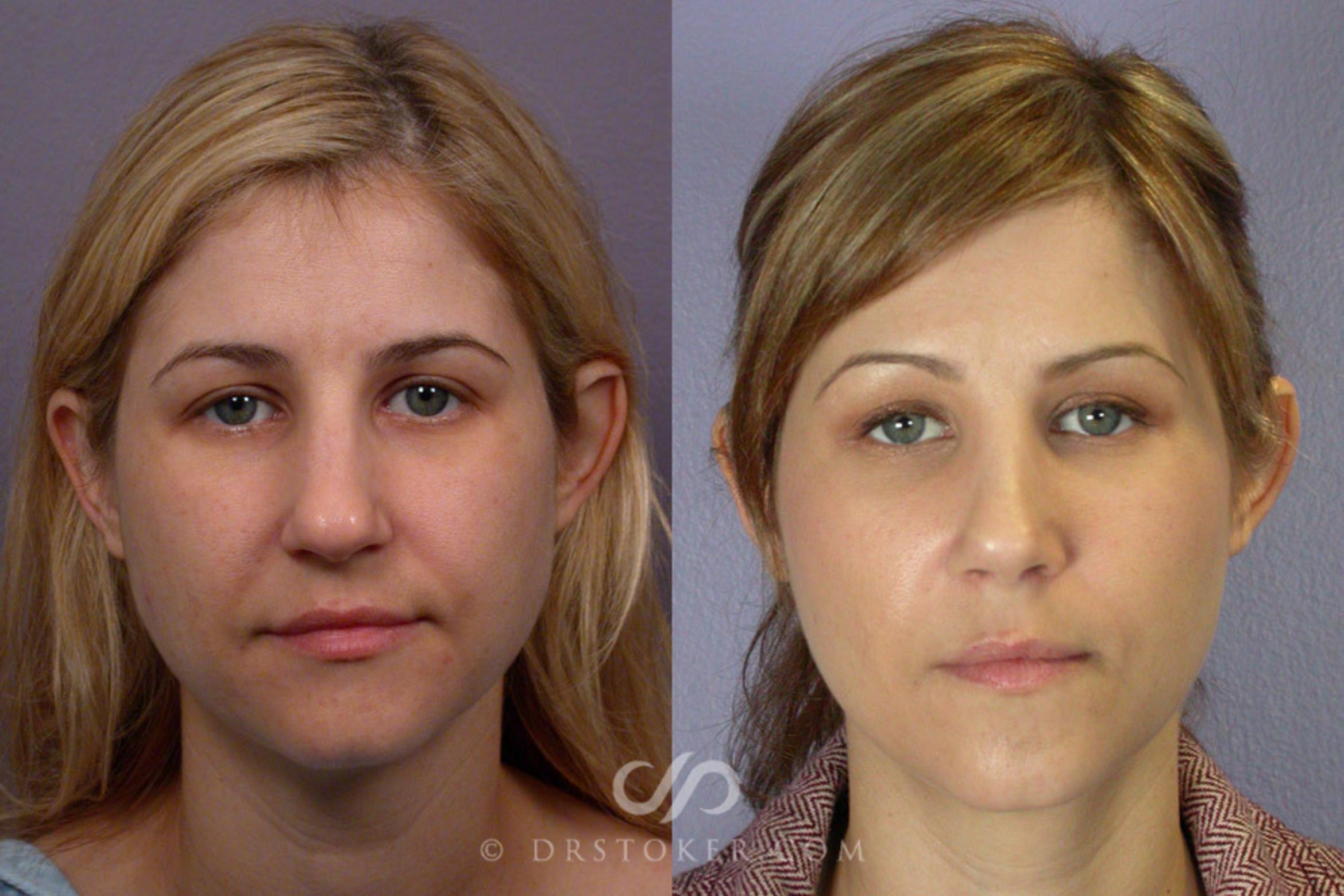 Before & After Rhinoplasty Case 266 View #1 View in Los Angeles, CA