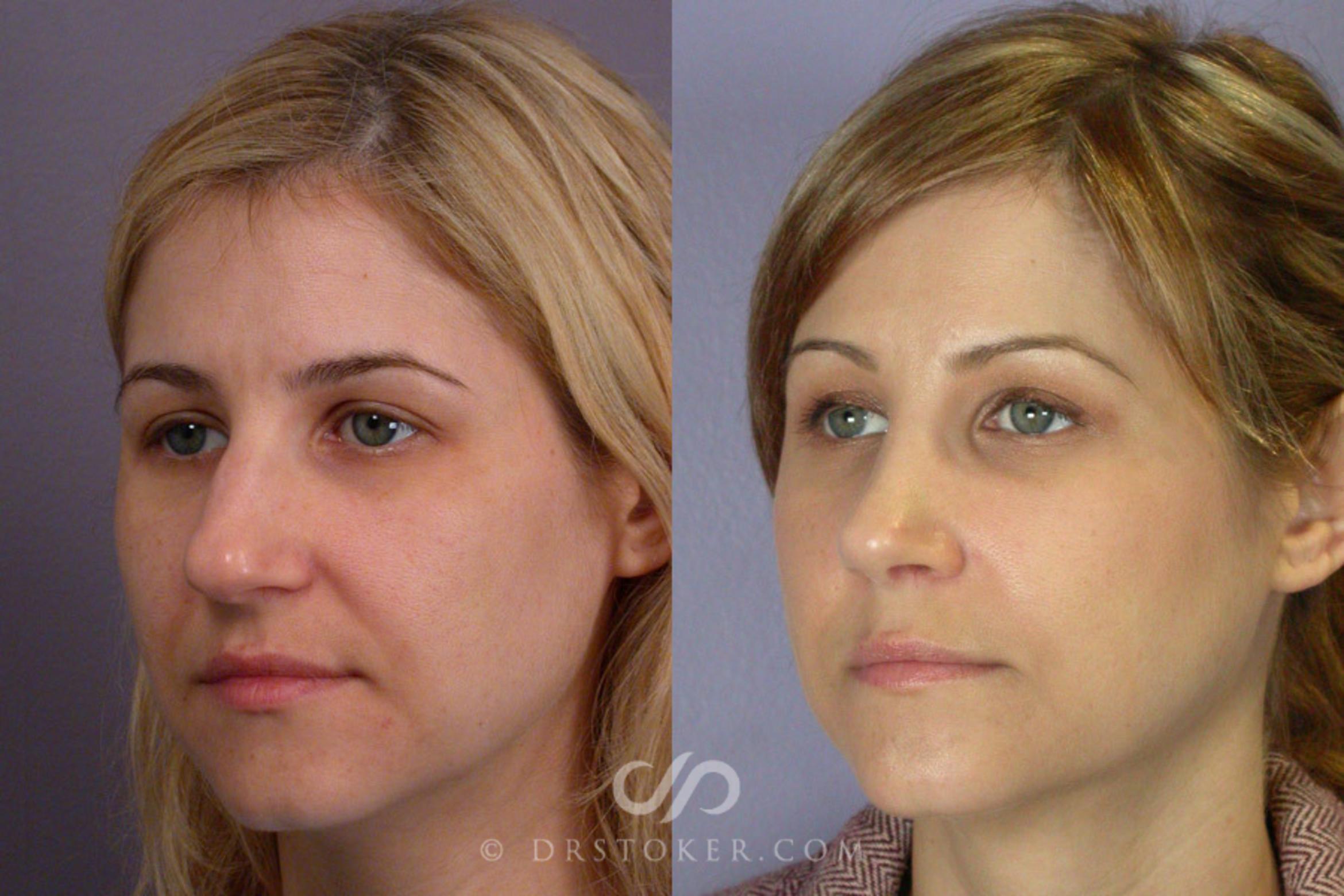 Before & After Rhinoplasty Case 266 View #3 View in Los Angeles, CA