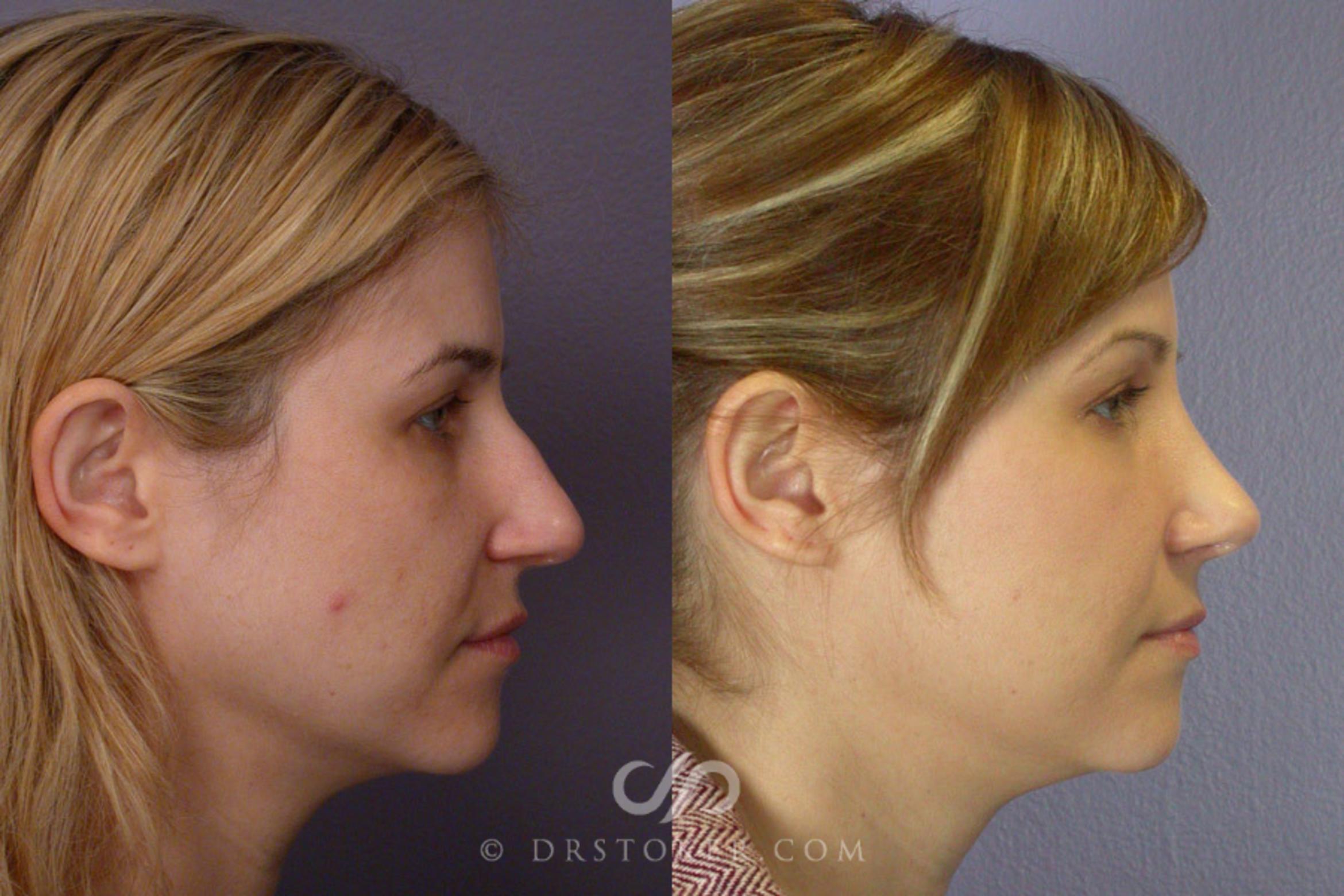 Before & After Rhinoplasty Case 266 View #4 View in Los Angeles, CA