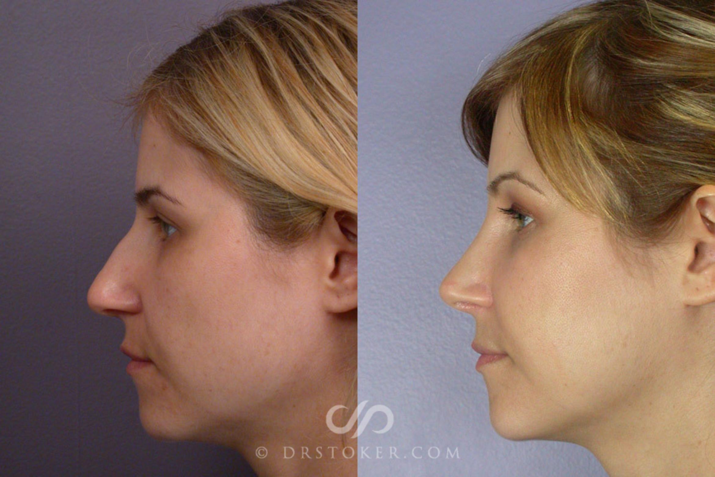 Before & After Rhinoplasty Case 266 View #5 View in Los Angeles, CA
