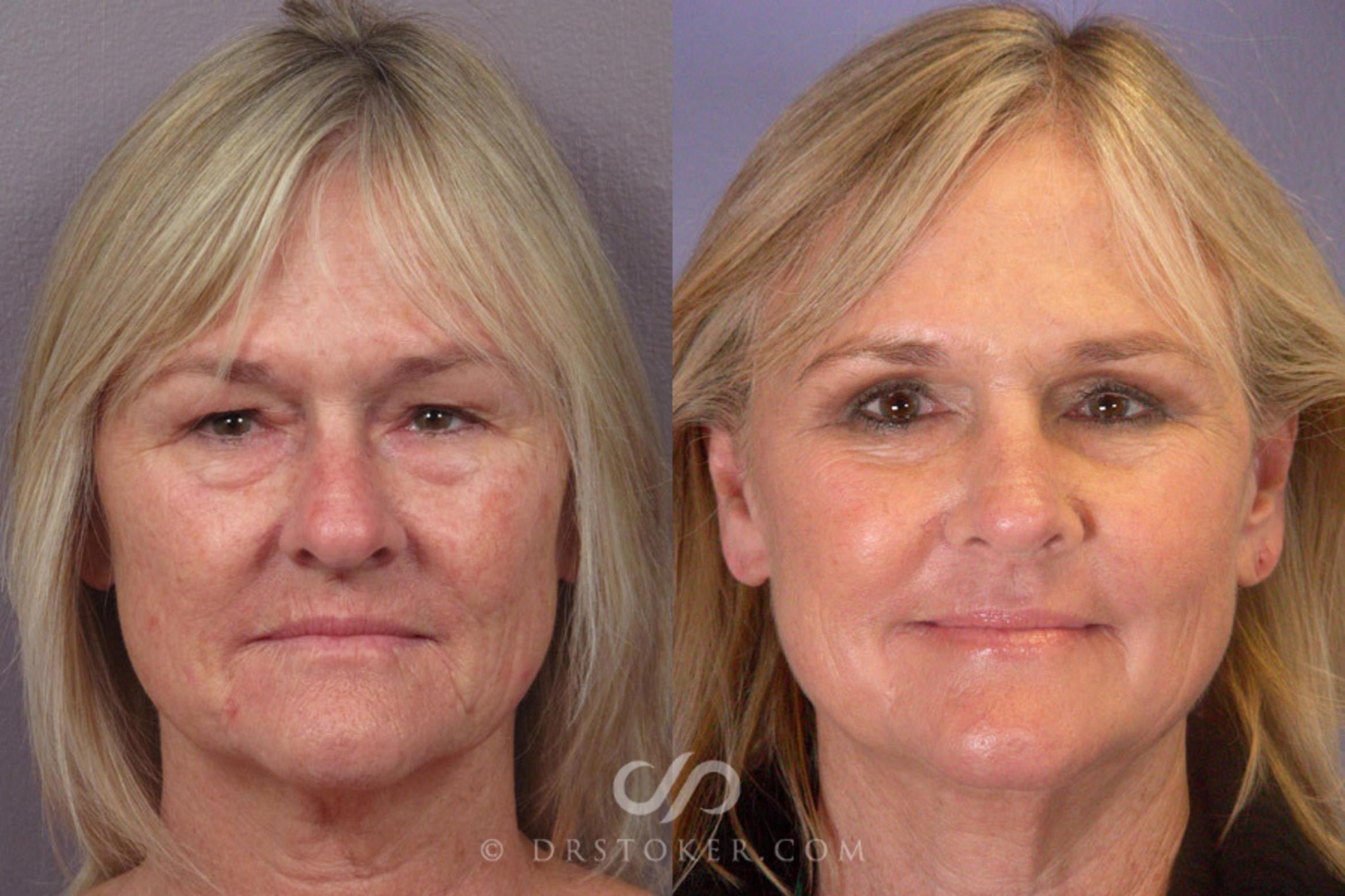 Before & After Laser Resurfacing  Case 279 View #1 View in Marina del Rey, CA