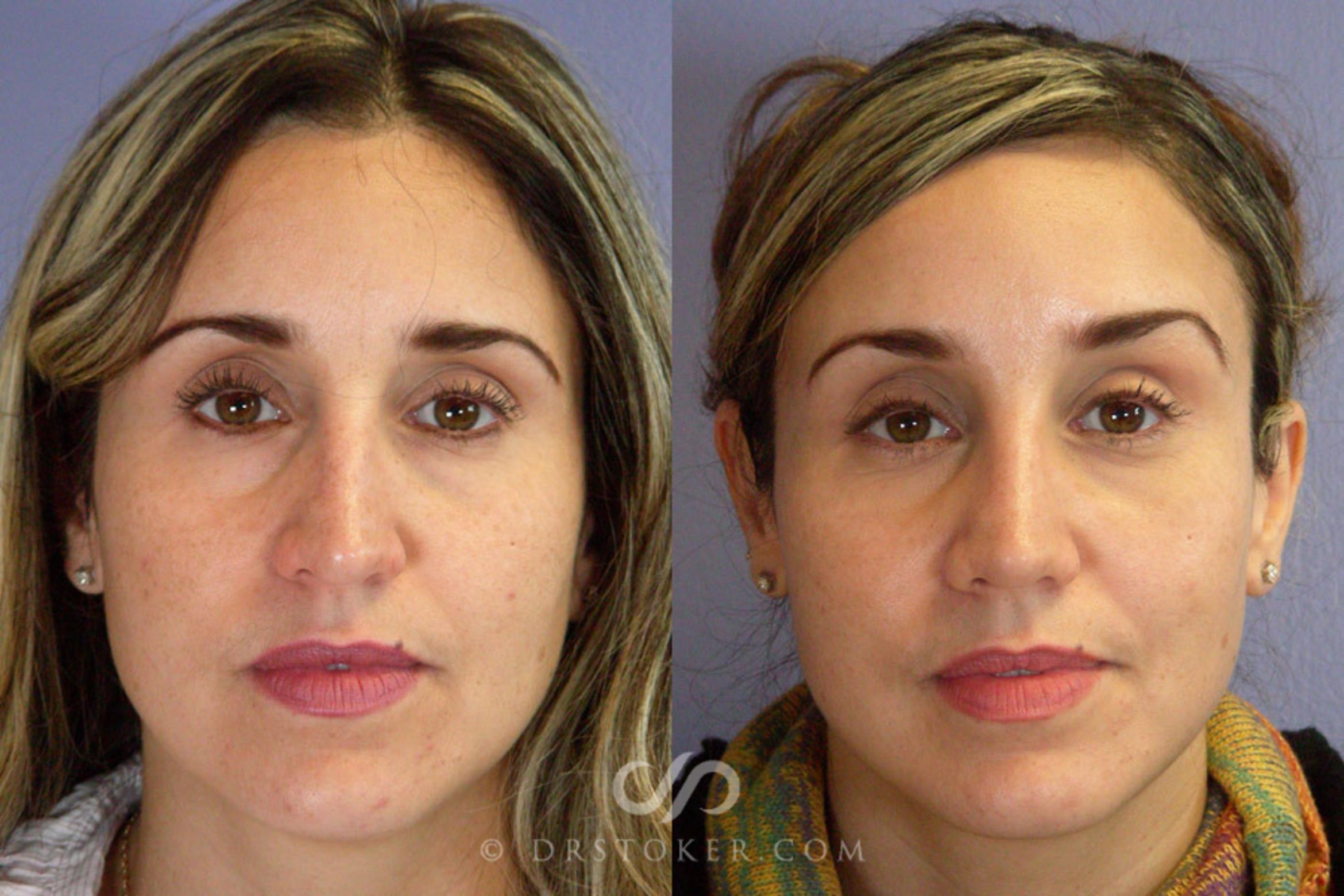 Nose Reshaping Before & After Photos Patient 292 Los