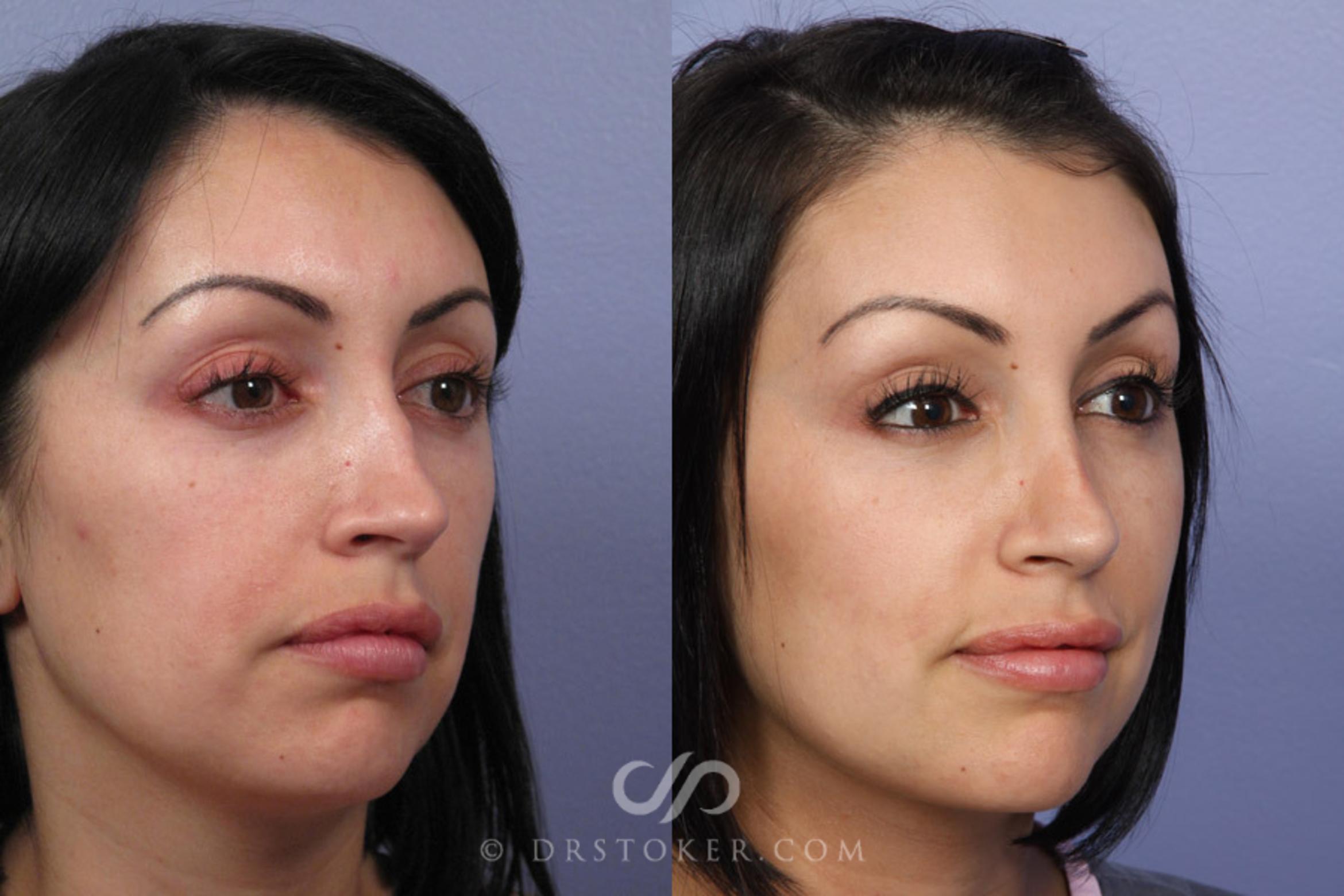 Before & After Rhinoplasty Case 307 View #1 View in Los Angeles, CA