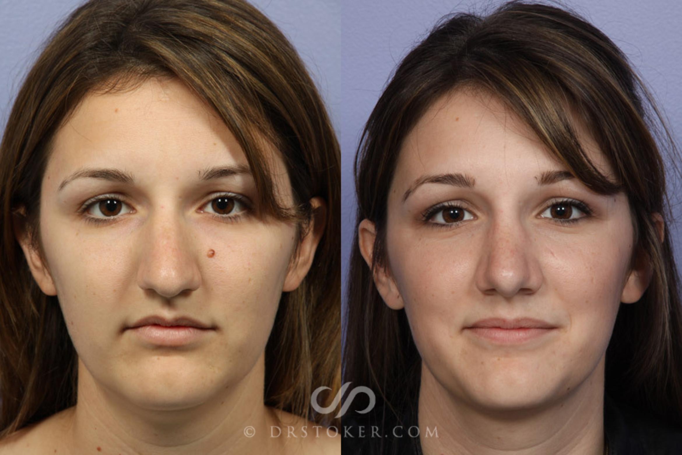 Before & After Rhinoplasty Case 334 View #1 View in Los Angeles, CA