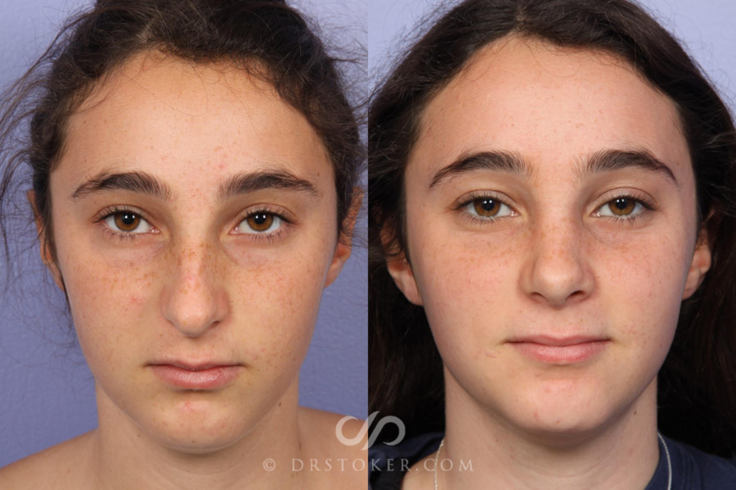 Before & After Rhinoplasty Case 335 View #1 View in Los Angeles, CA