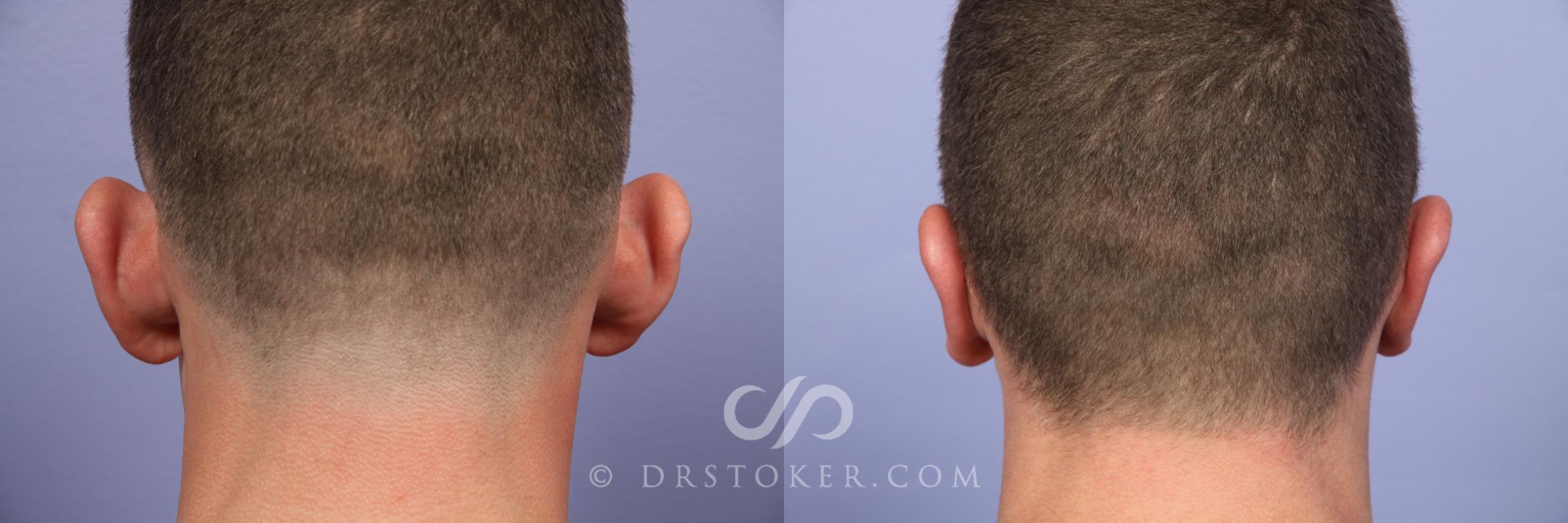 Before & After Rhinoplasty Case 417 View #2 View in Los Angeles, CA