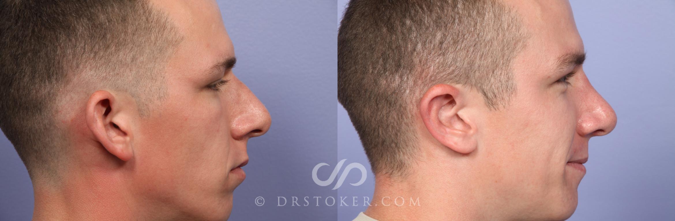 Before & After Rhinoplasty Case 417 View #3 View in Los Angeles, CA