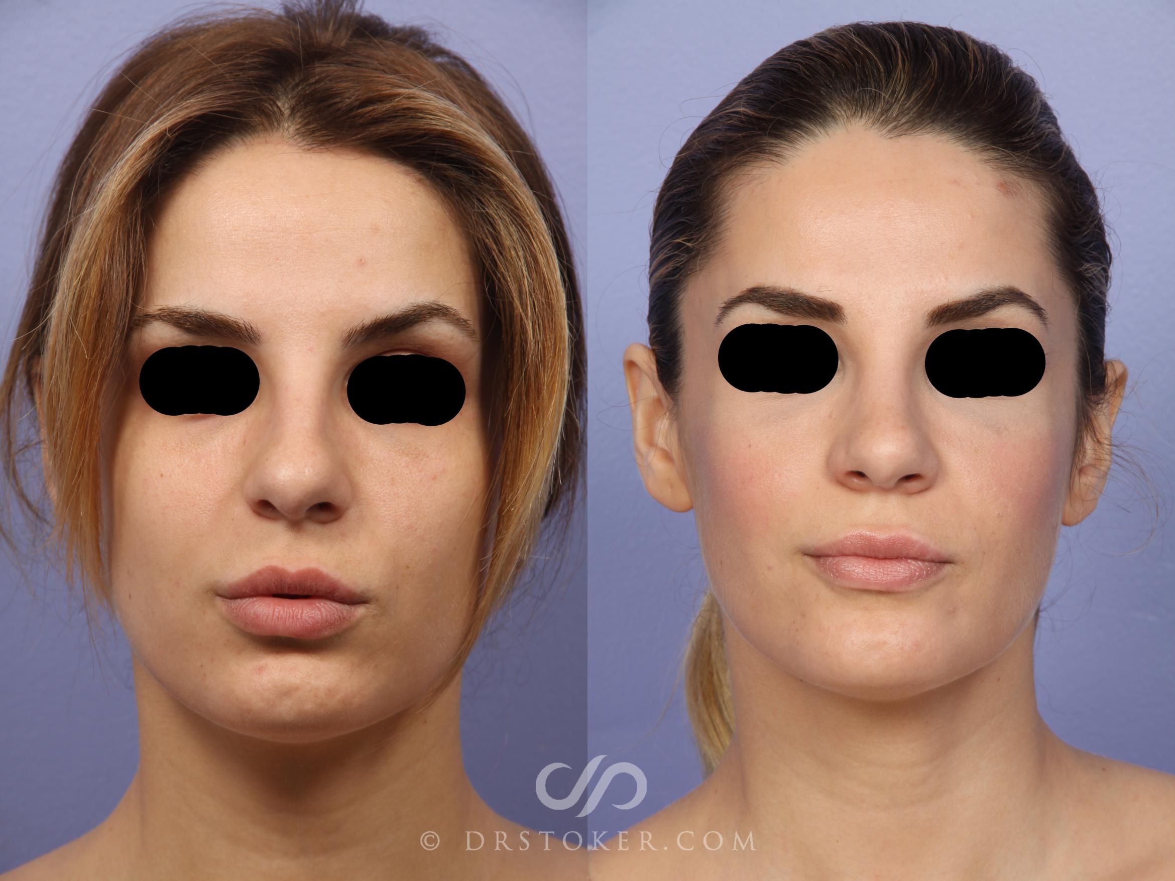 Before & After Rhinoplasty Case 467 View #1 View in Los Angeles, CA