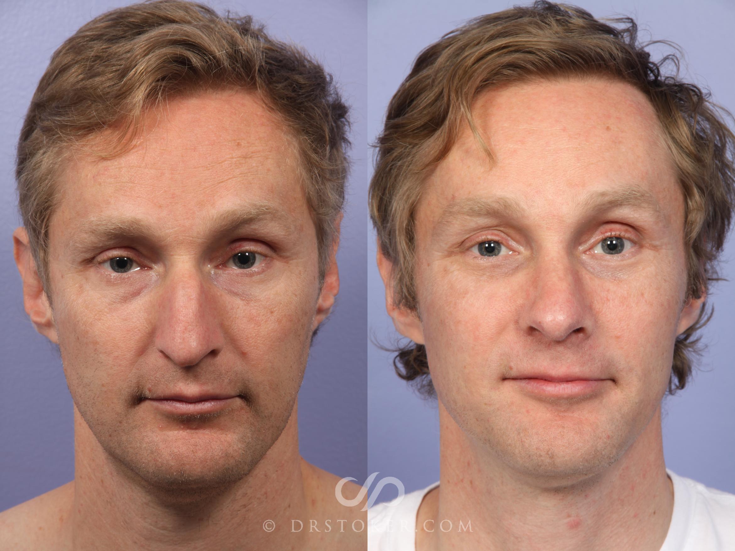 Before & After Rhinoplasty Case 524 View #1 View in Los Angeles, CA