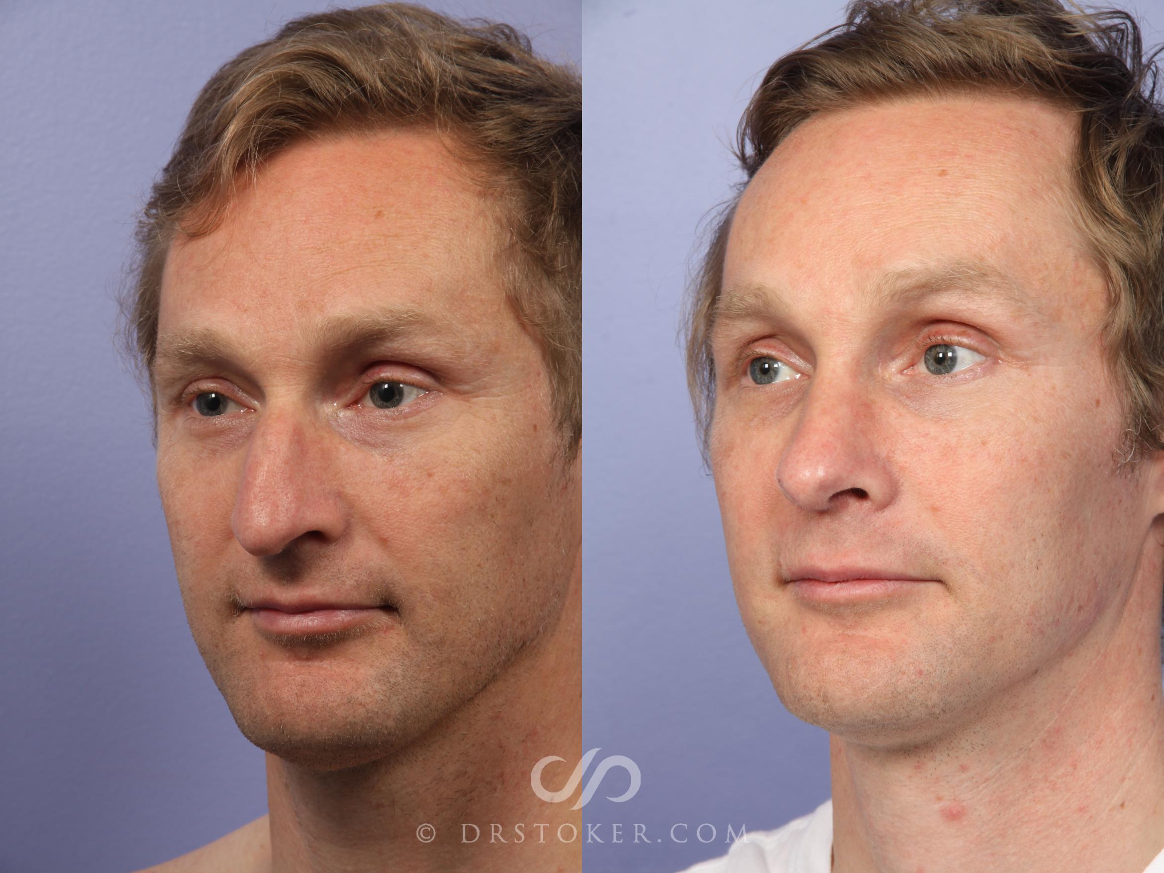 Before & After Rhinoplasty Case 524 View #4 View in Los Angeles, CA