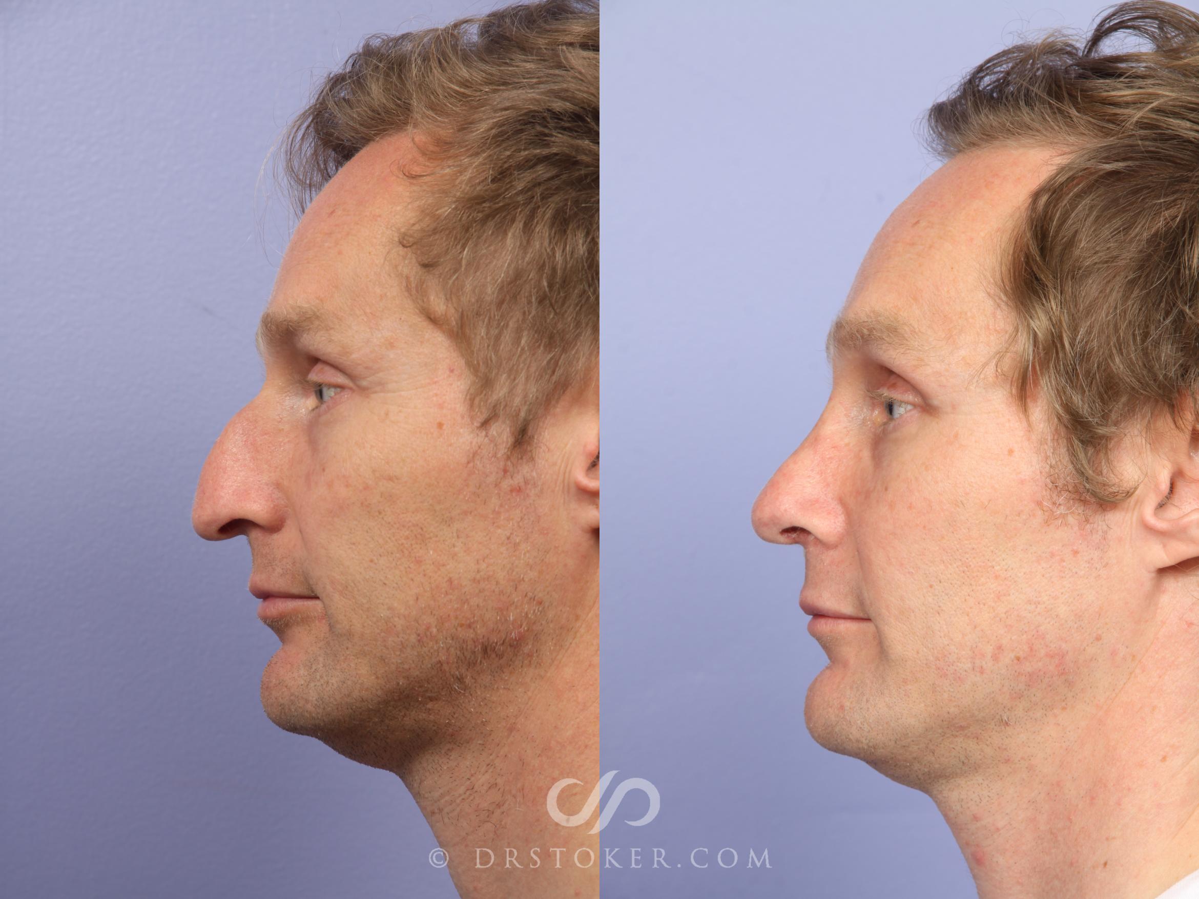 Before & After Rhinoplasty Case 524 View #5 View in Los Angeles, CA