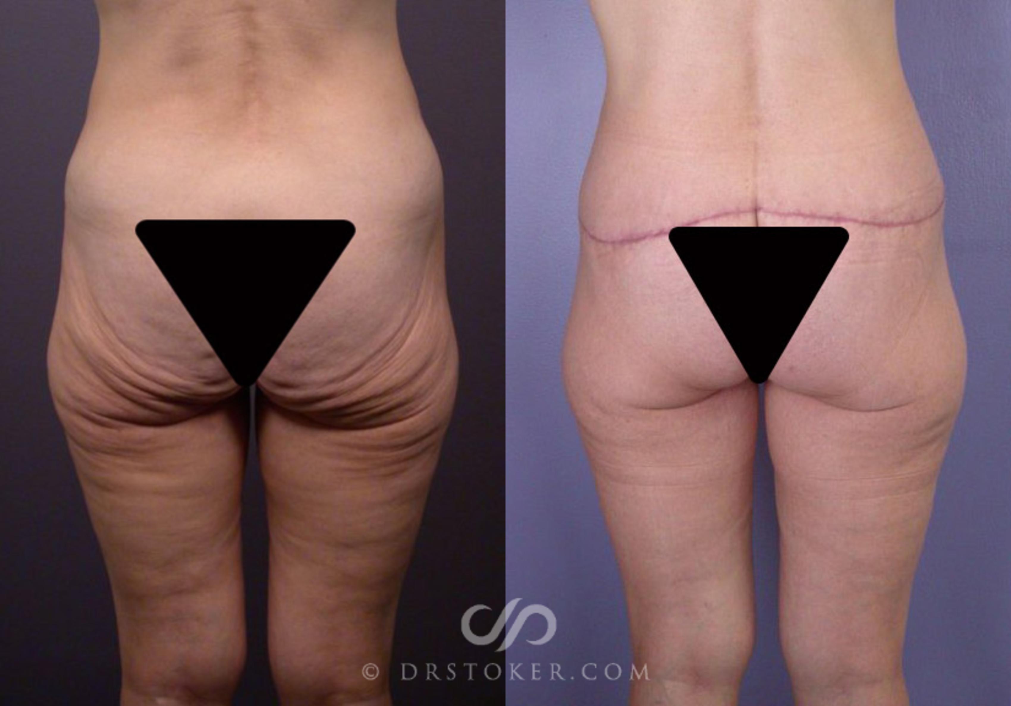 Before & After Posterior Lift Case 110 View #1 View in Los Angeles, CA
