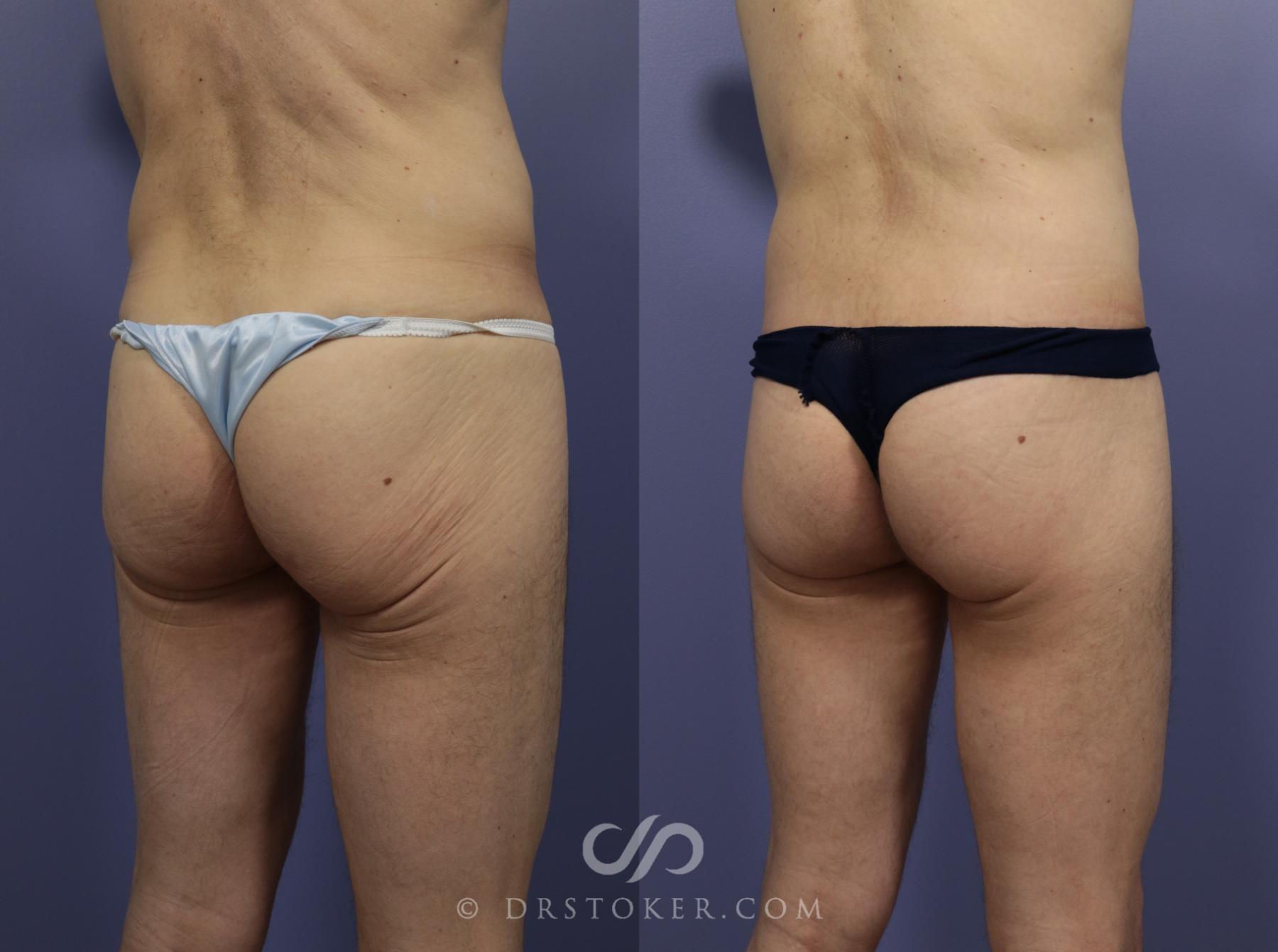 Before & After Posterior Lift Case 1174 View #1 View in Los Angeles, CA
