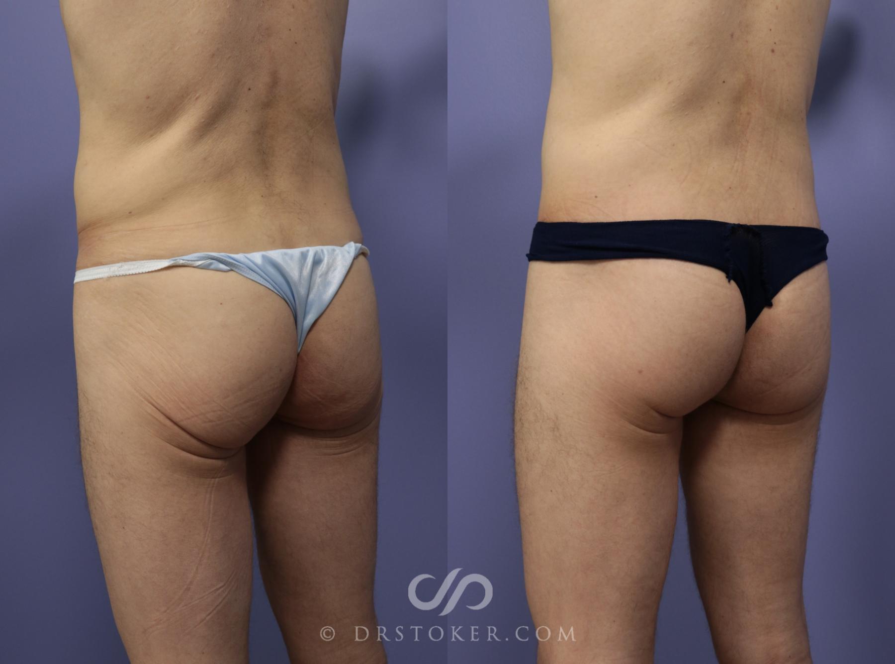 Before & After Posterior Lift Case 1174 View #2 View in Los Angeles, CA