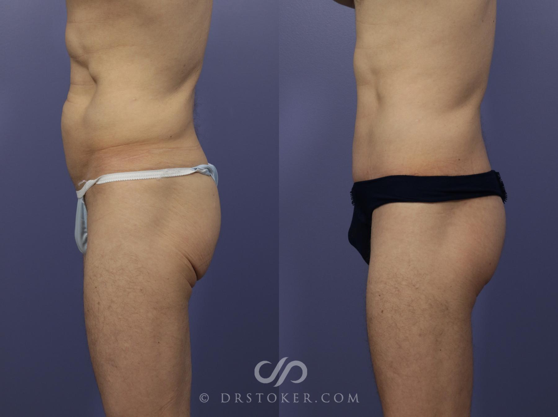 Before & After Posterior Lift Case 1174 View #3 View in Los Angeles, CA