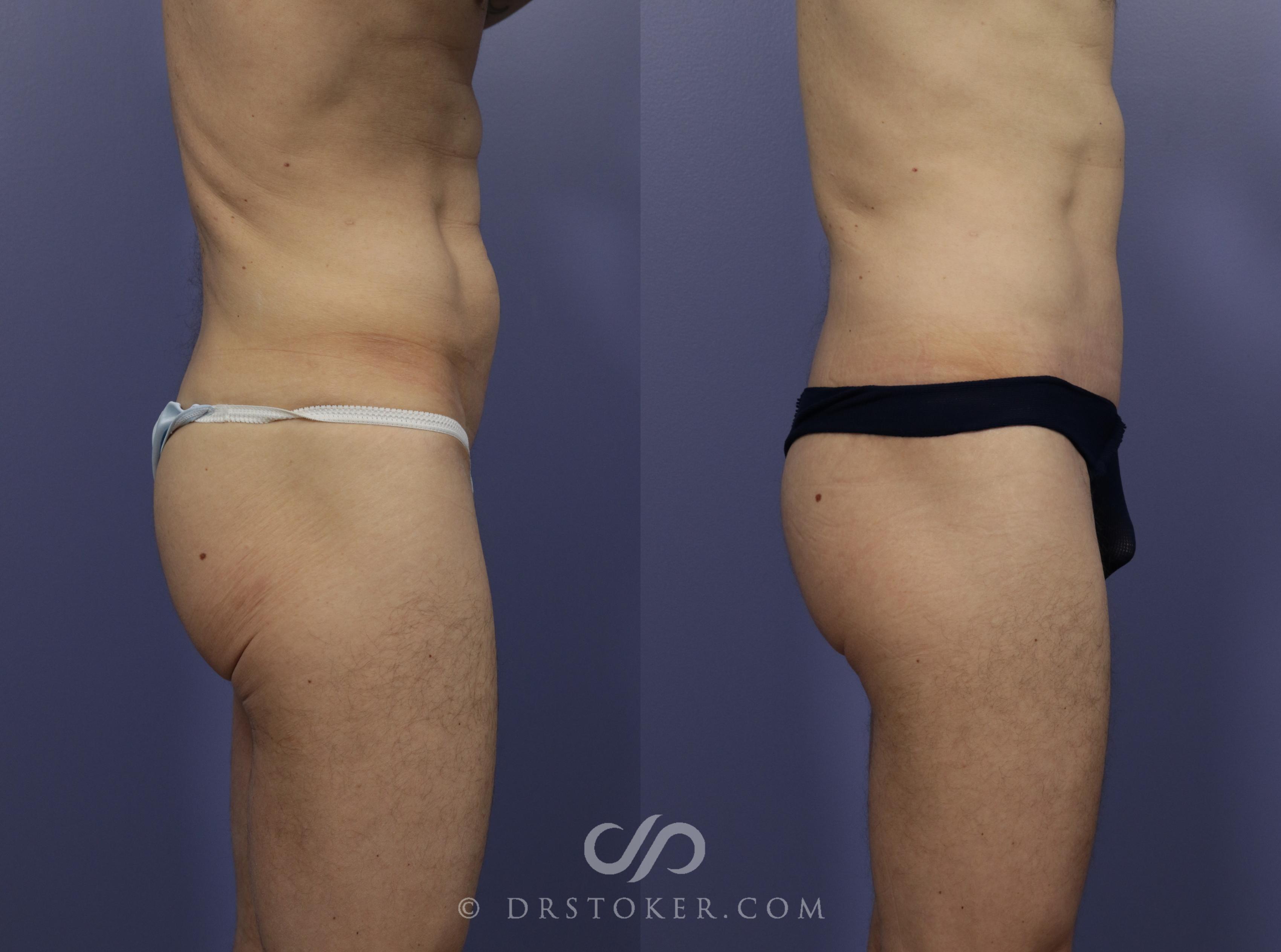 Before & After Posterior Lift Case 1174 View #4 View in Los Angeles, CA