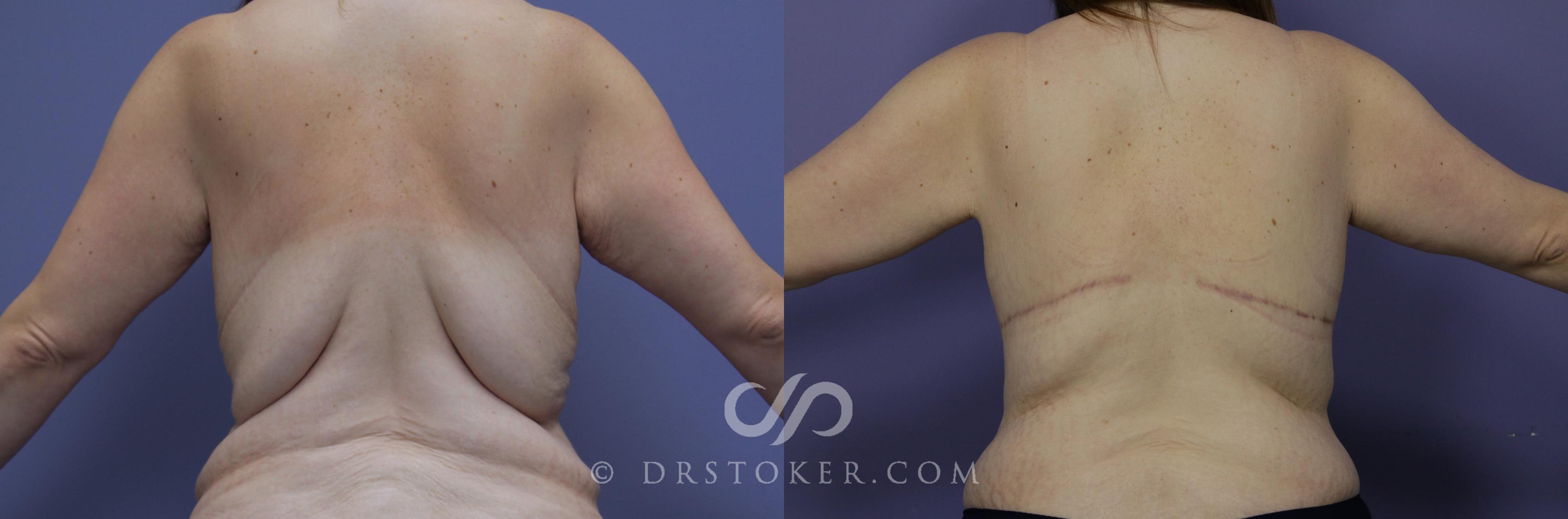 Before & After Posterior Lift Case 1175 View #1 View in Los Angeles, CA