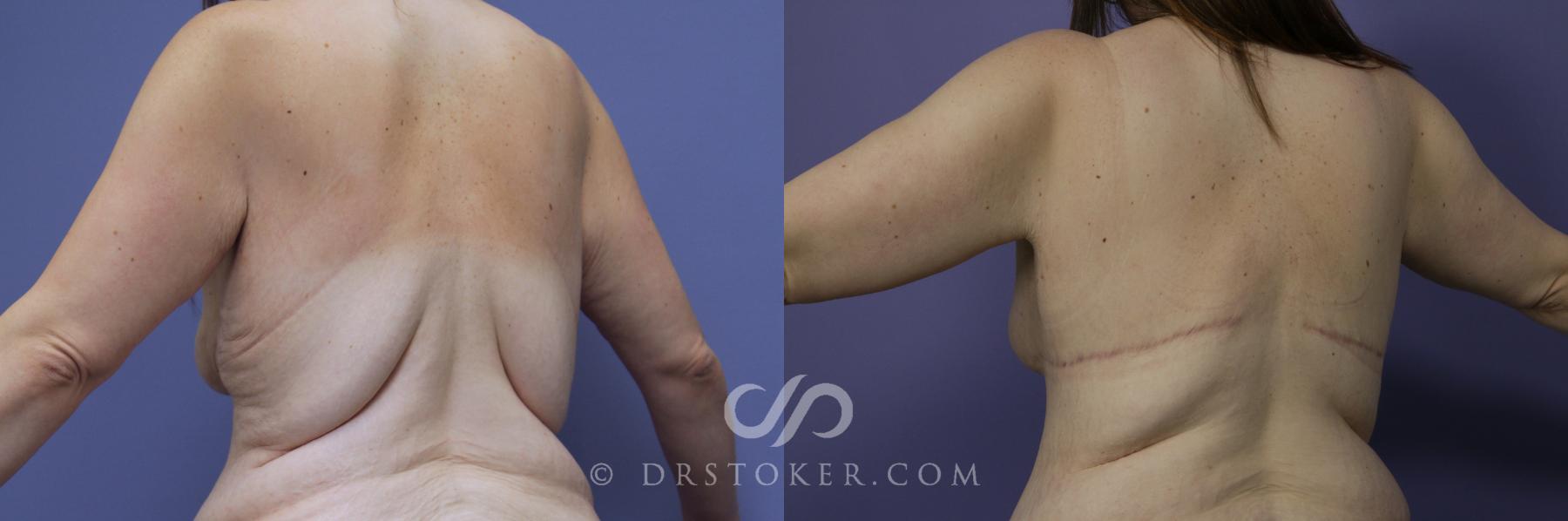 Before & After Posterior Lift Case 1175 View #2 View in Los Angeles, CA